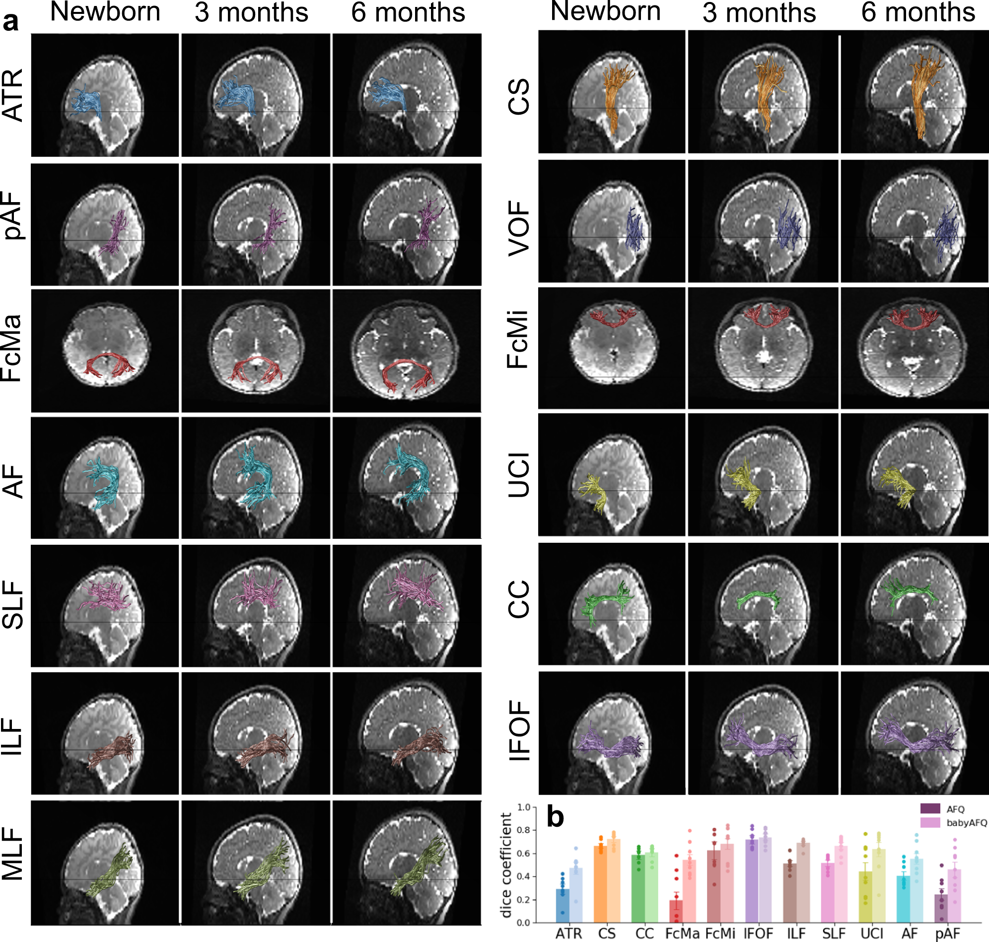 White matter myelination during early infancy is linked to spatial  gradients and myelin content at birth | Nature Communications