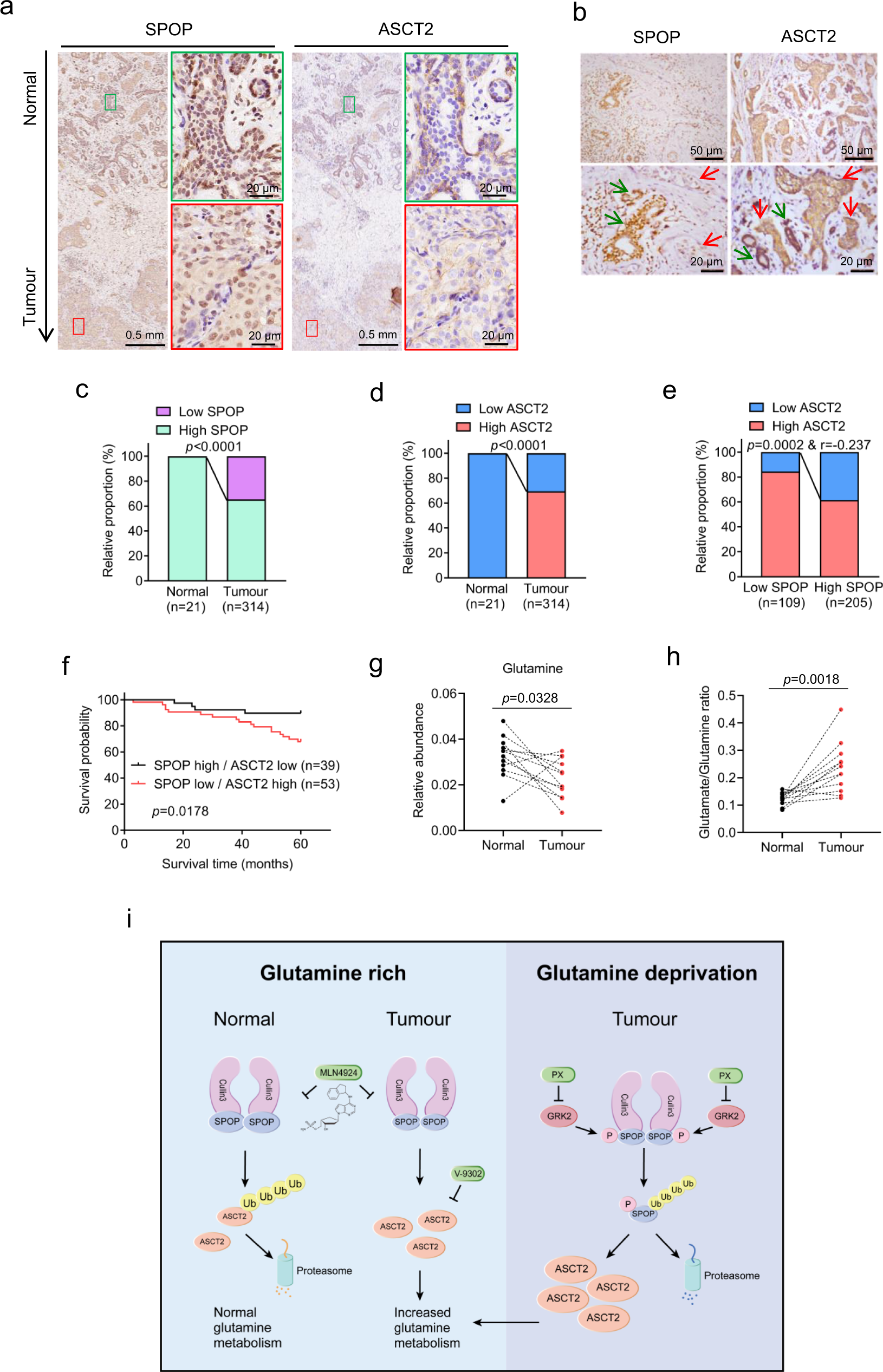 Fig. 7: Inverse correlation of SPOP and ASCT2 levels in breast cancer tissues and their association with patient survival.