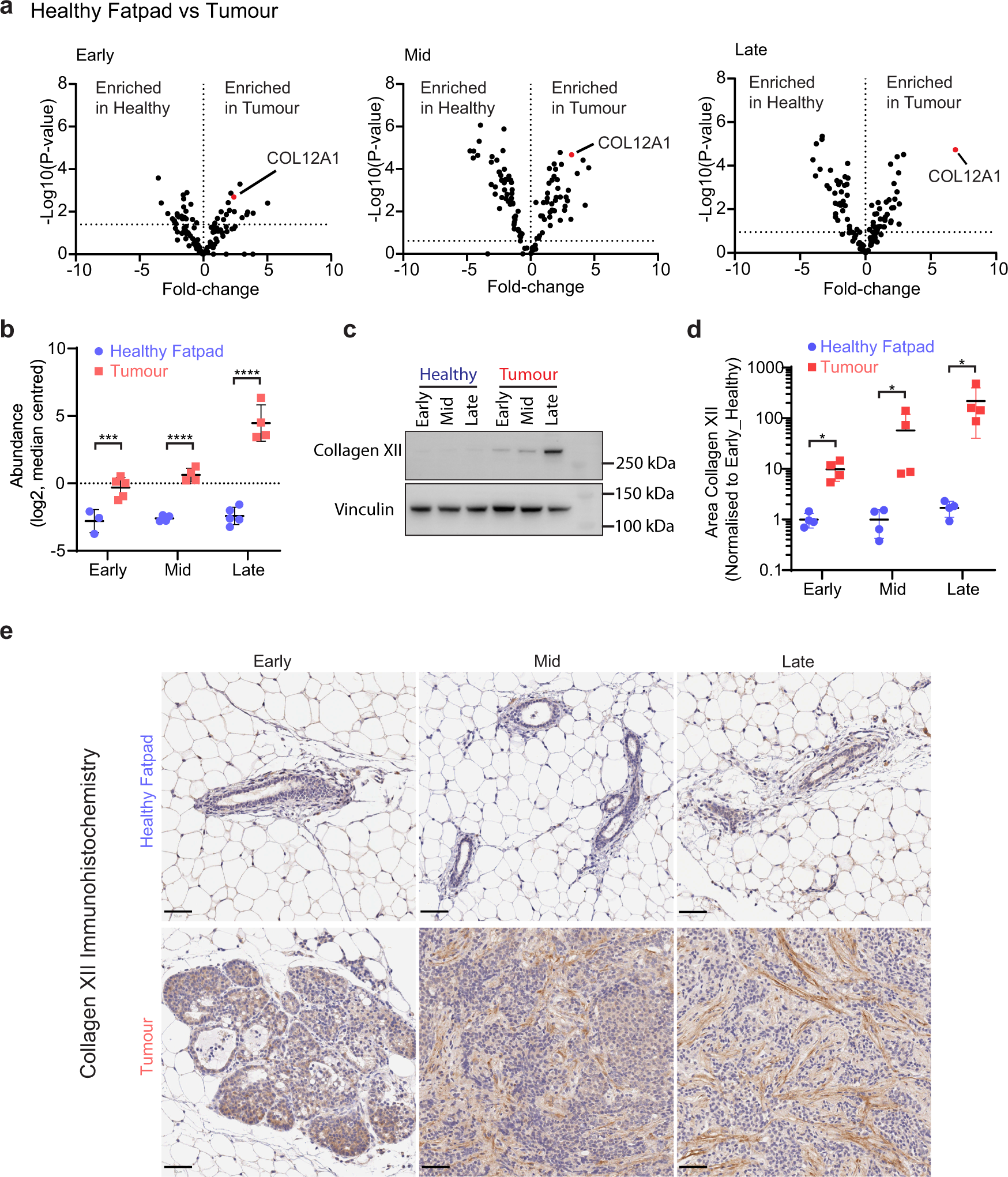 Fig. 2: Collagen XII is upregulated in breast tumours as the disease progresses.