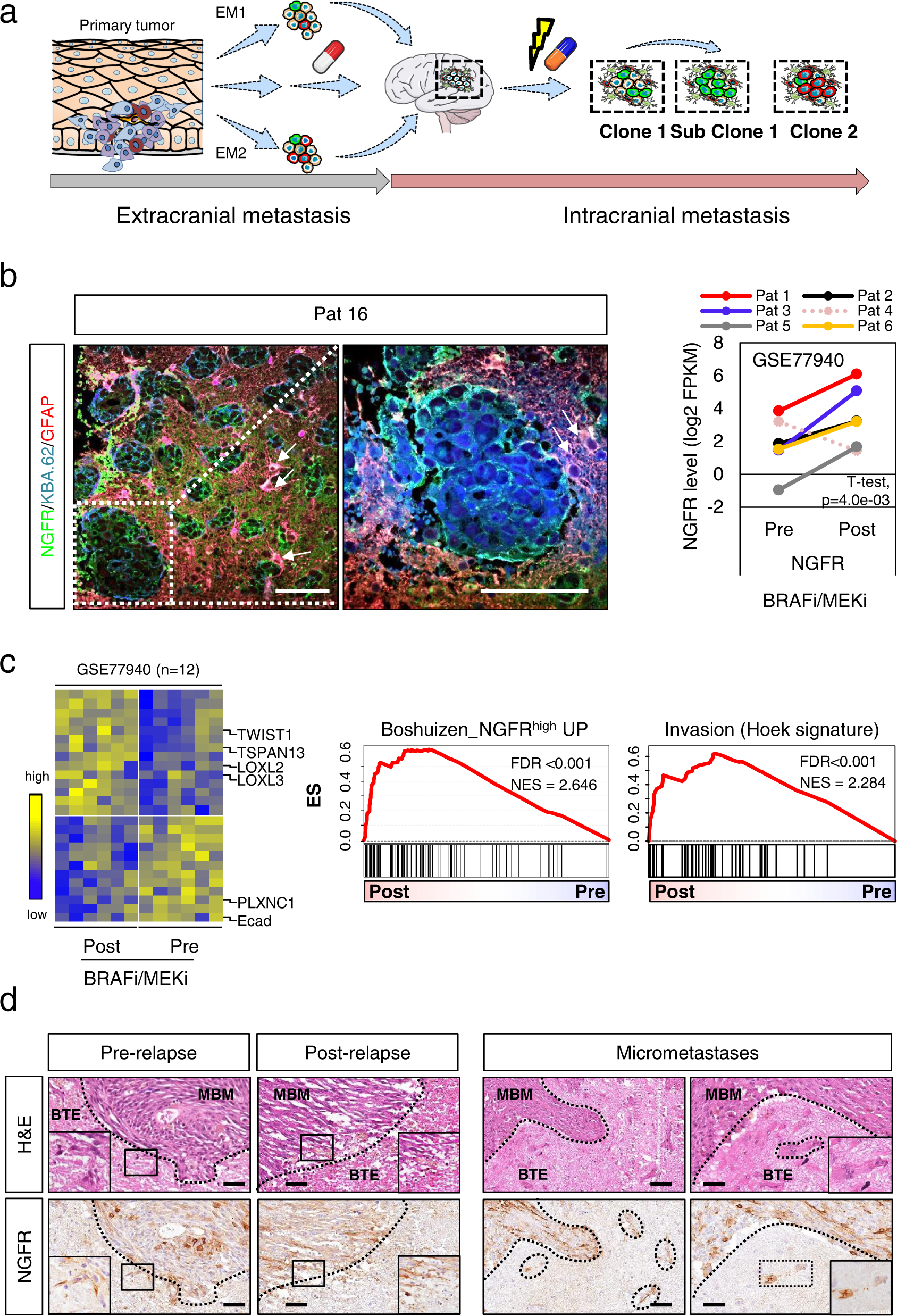 Combined Nivolumab and Ipilimumab in Melanoma Metastatic to the Brain