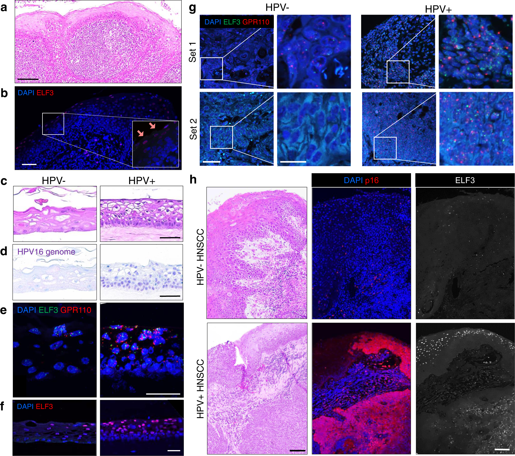 Fig. 9: HIDDEN cells are detected in HPV+ tonsil-derived epithelium and in HNSCC patient biopsies.