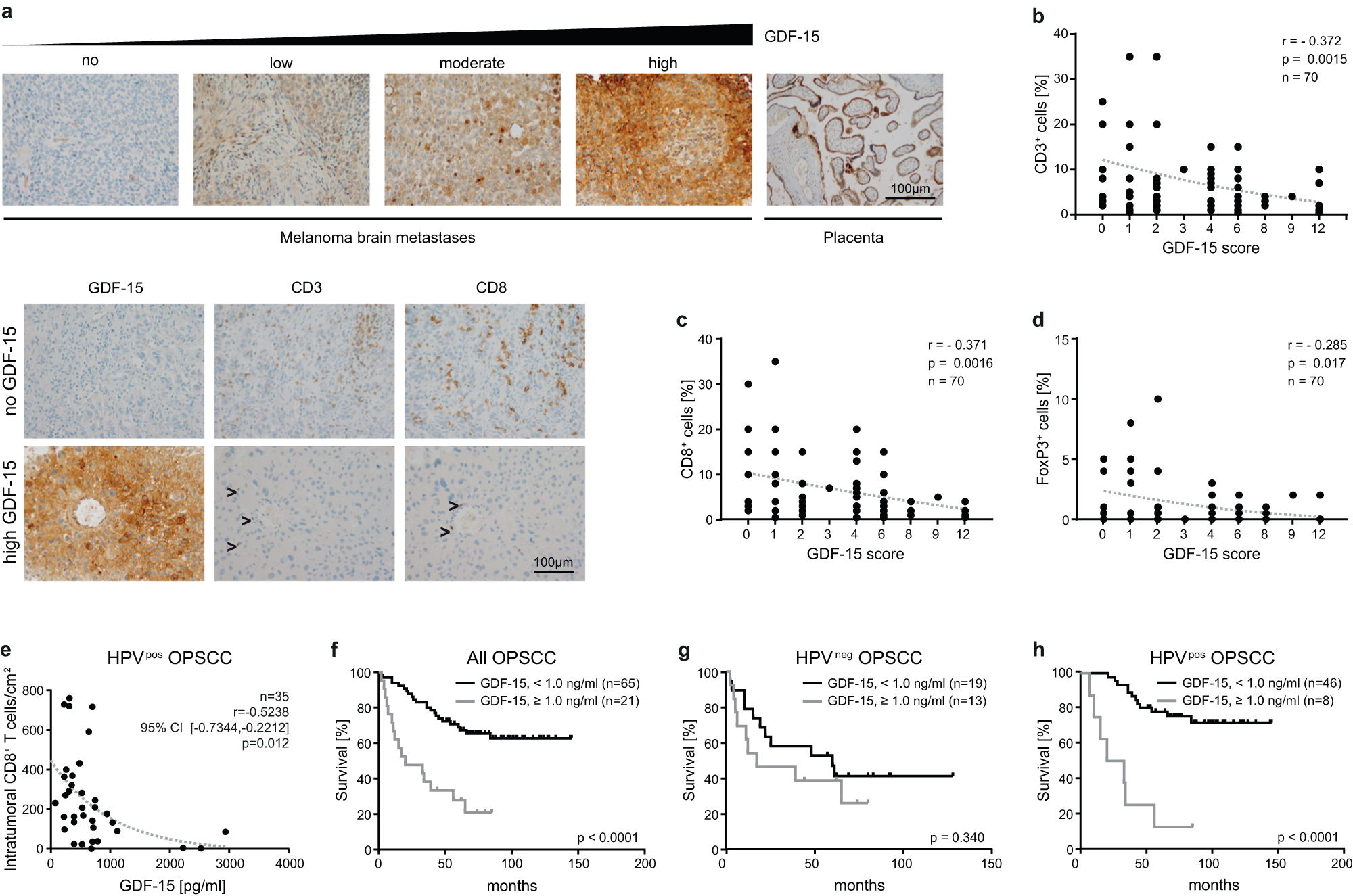 Fig. 5: GDF-15 expression is negatively correlated with intratumoral T cell infiltration in brain metastases from melanoma patients and in HPV+ oropharyngeal squamous cell carcinomas.
