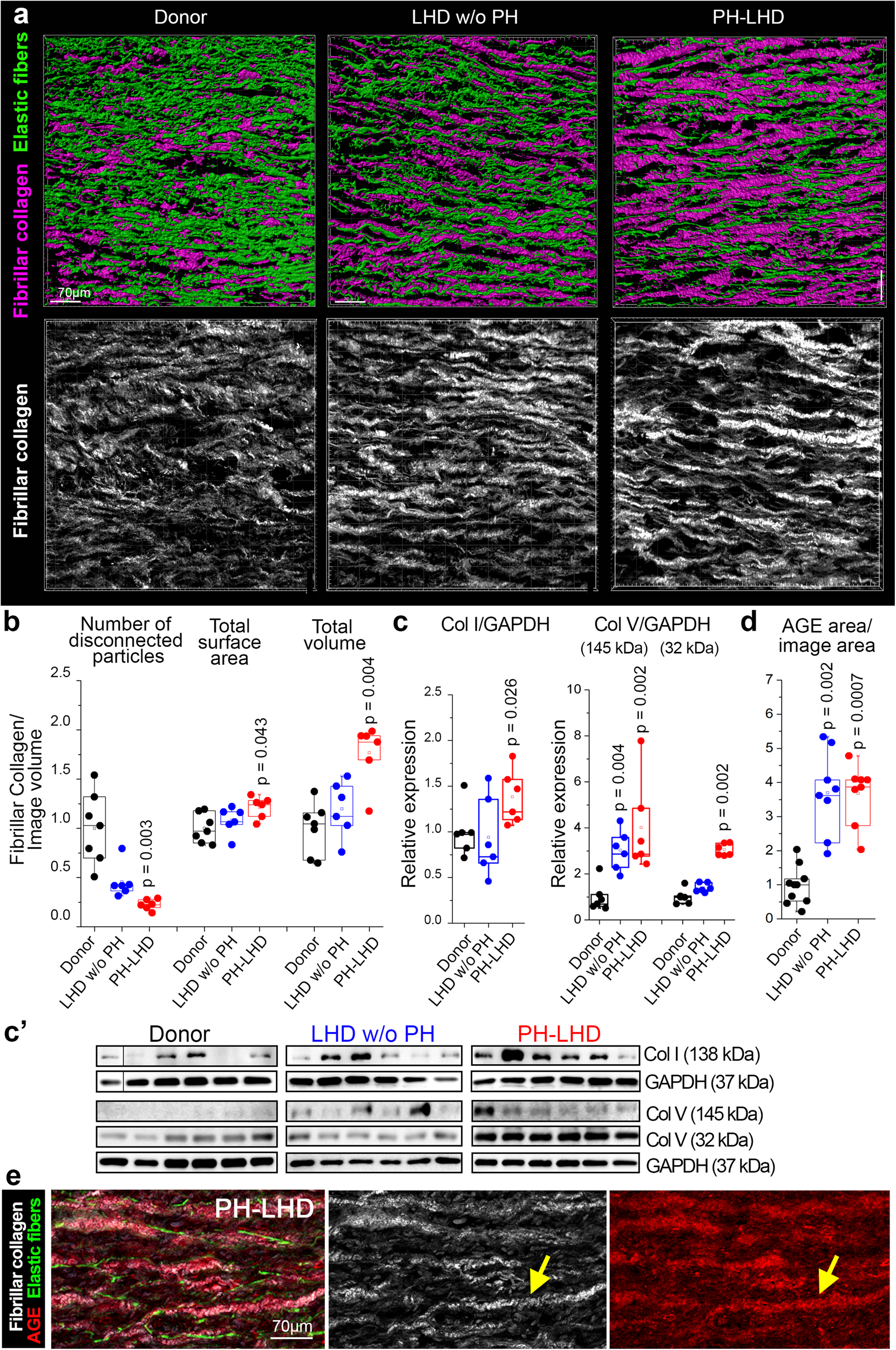 Fig. 4: Increased deposition of fibrillar collagen.