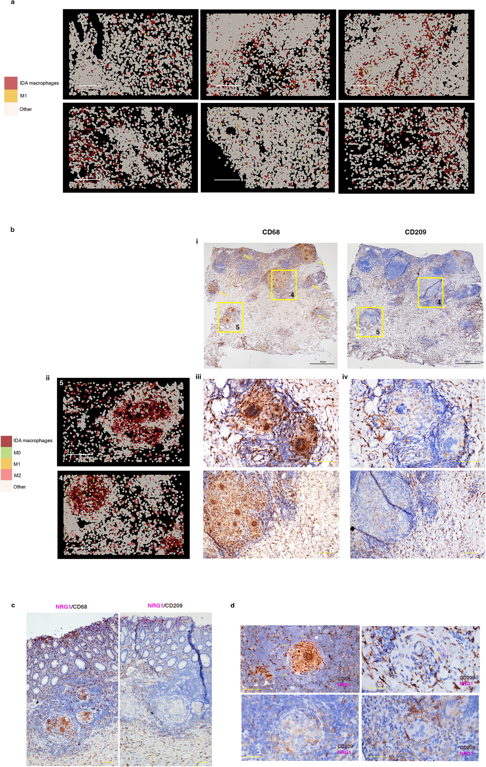 Fig. 4: Inflammation-Dependent Alternative (IDA) macrophages are widely distributed in ulcerative colitis and present in Crohn’s disease granulomas.