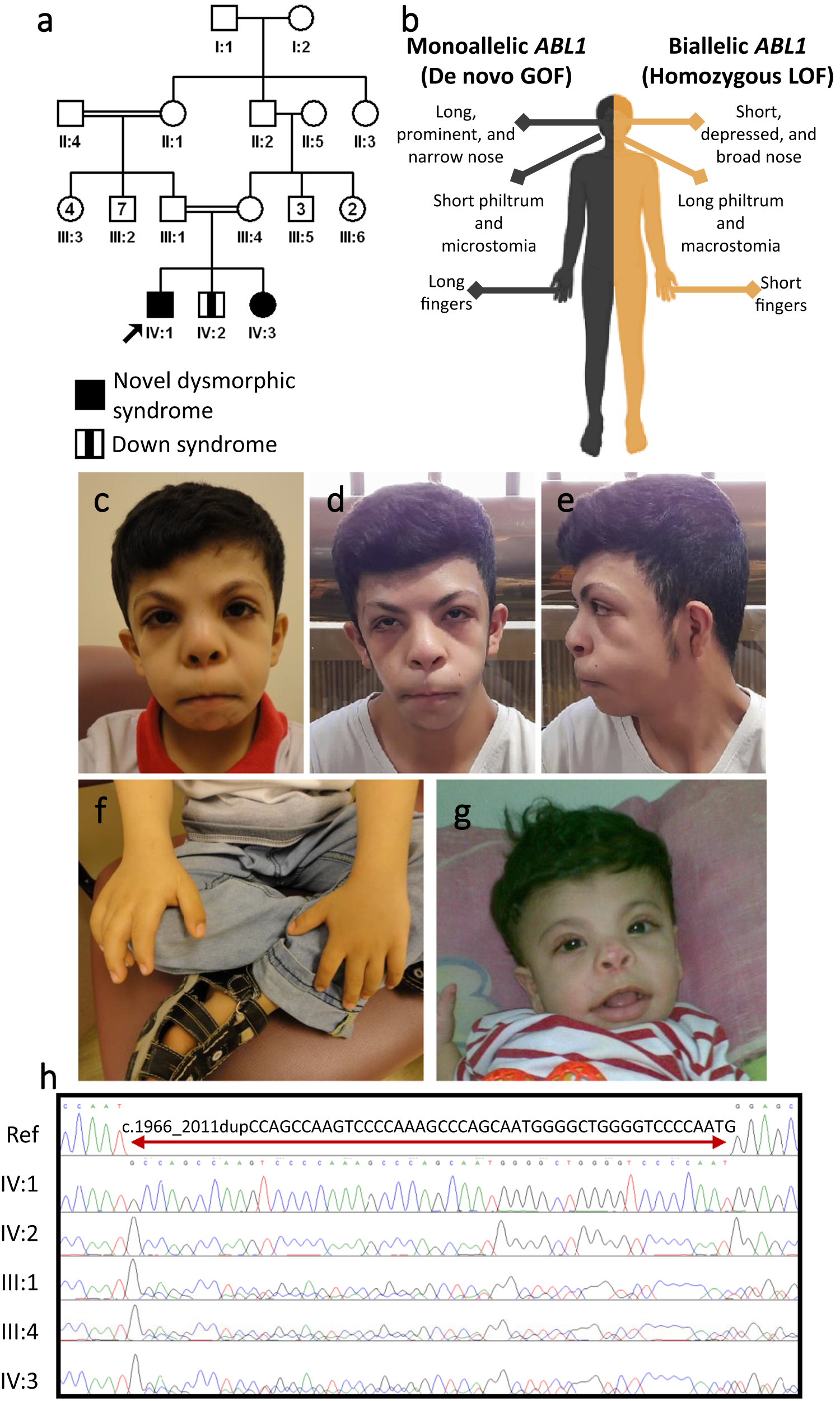 Fig. 3: A novel allelic disorder caused by biallelic LOF in ABL1.