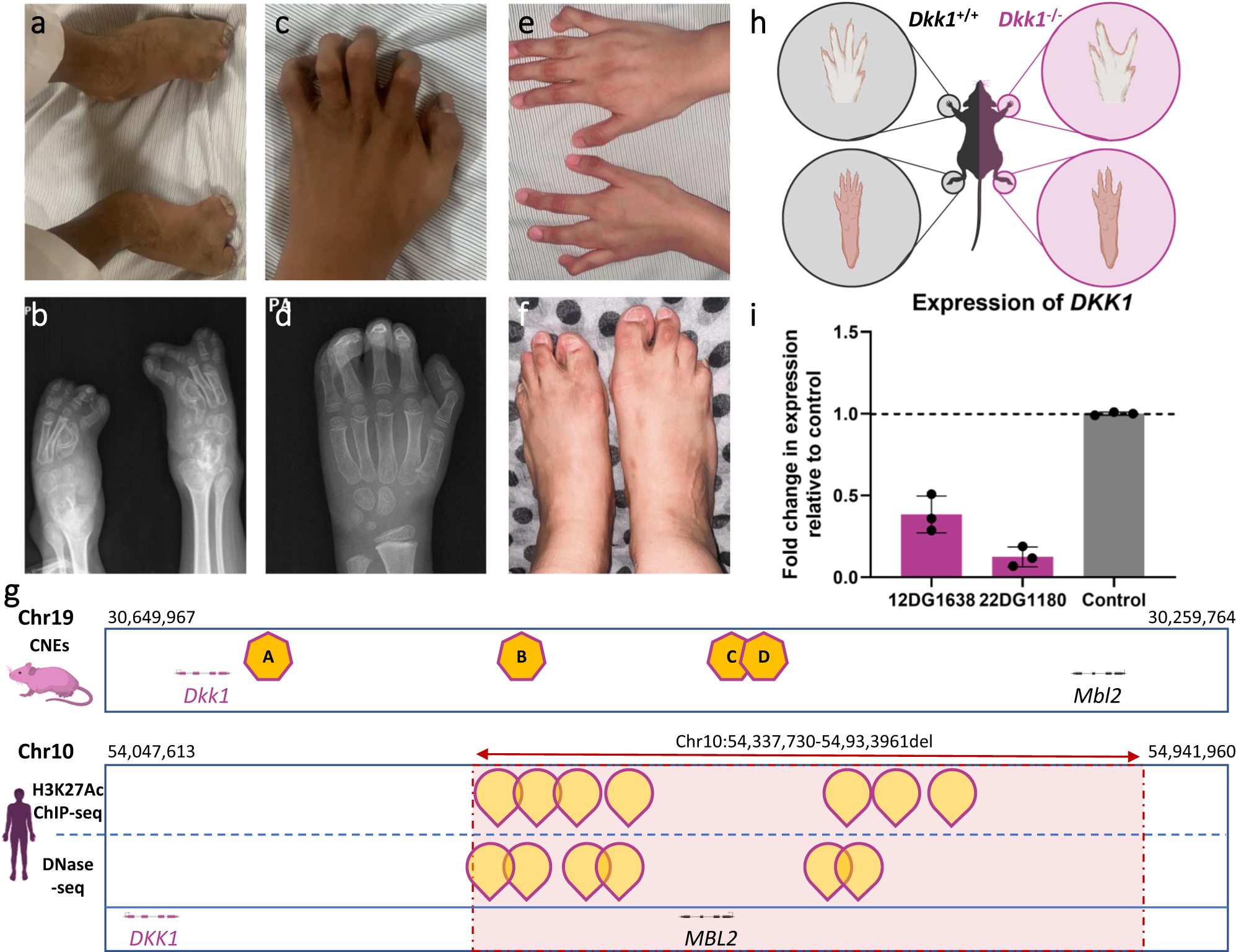 Fig. 4: Identification of a homozygous deletion affecting the regulatory elements of DKK1 in four siblings with complex syndactyly.