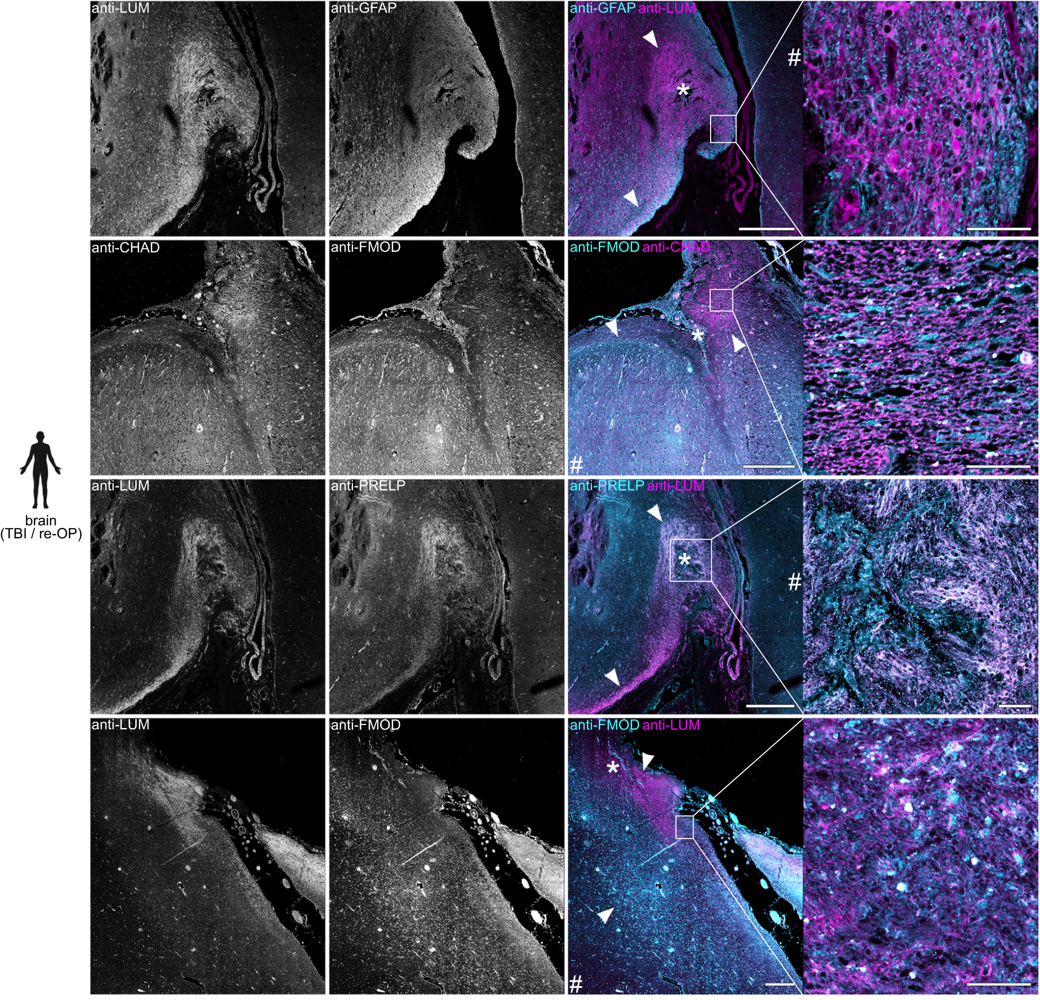 Fig. 3: SLRPs are enriched in human brain lesions.