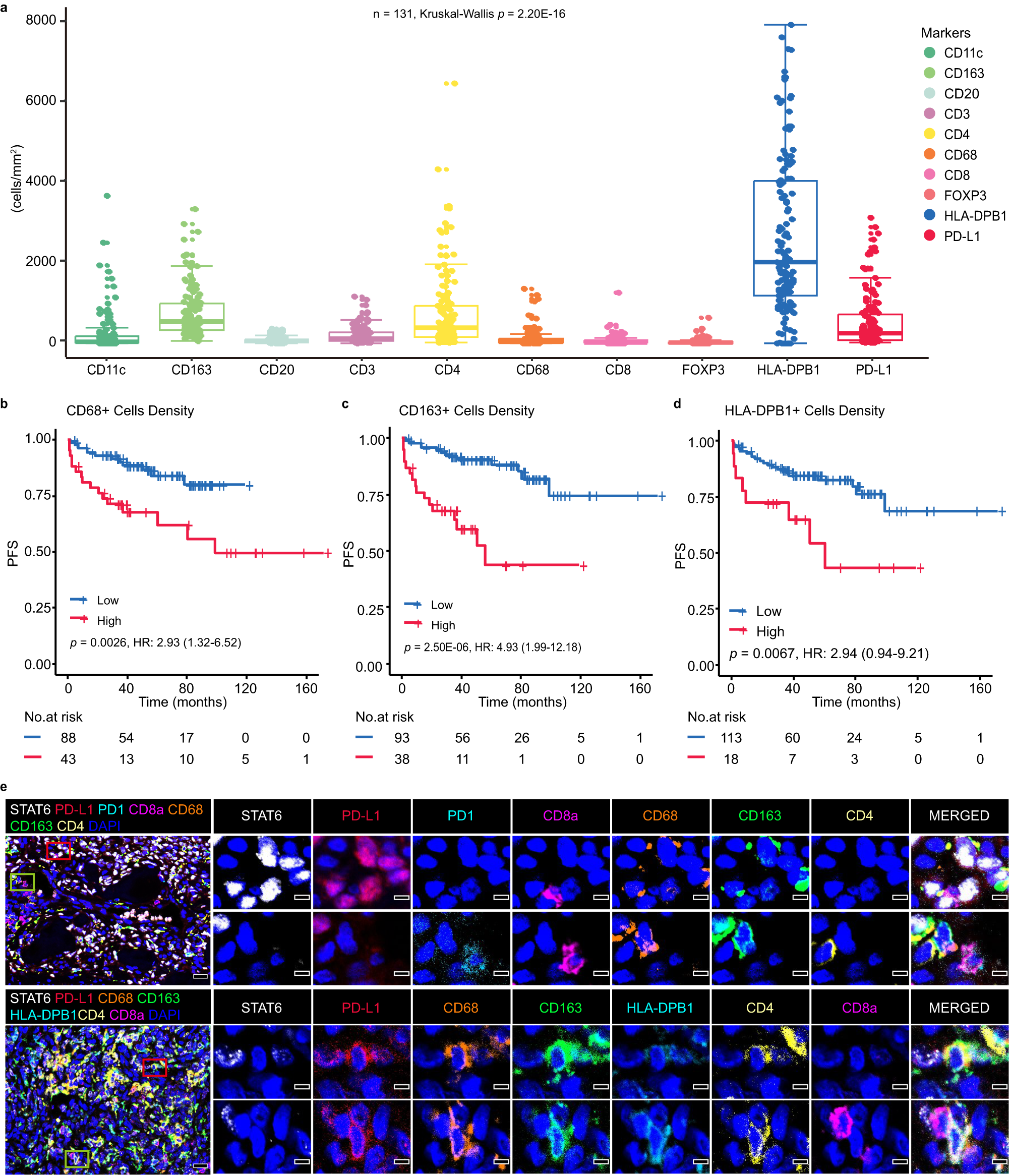 Fig. 3: High density of macrophages and high PD-L1 expression were found in SFTs.