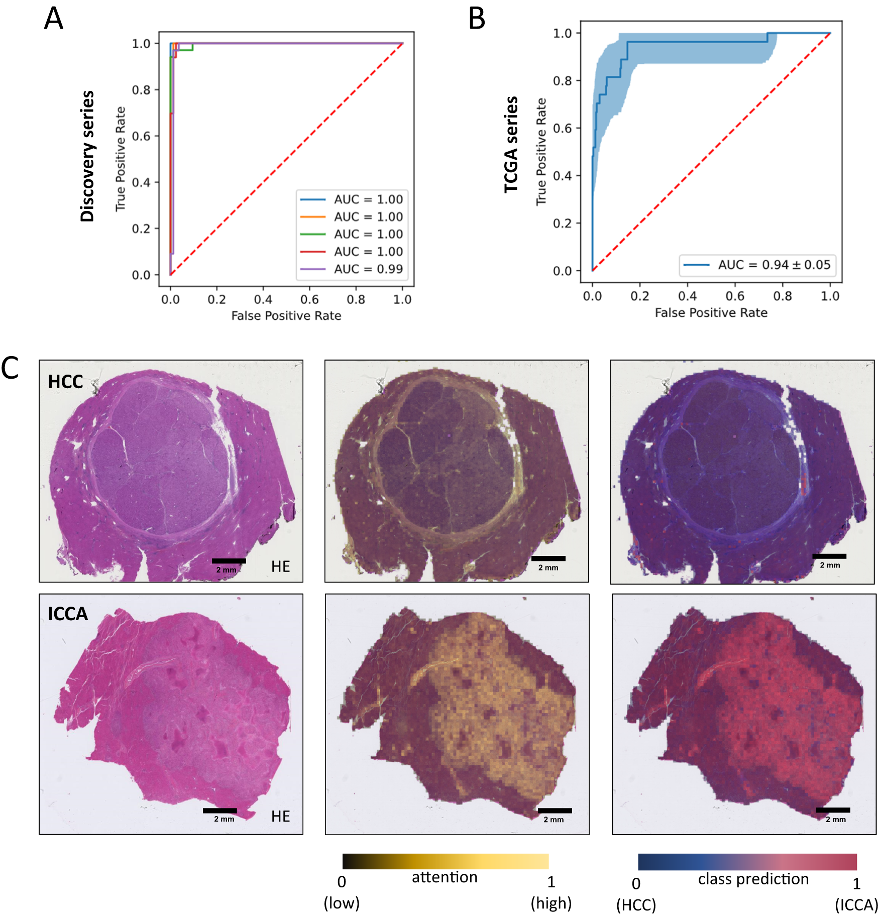 Fig. 2: Development of a deep-learning model for HCC/ICCA classification.