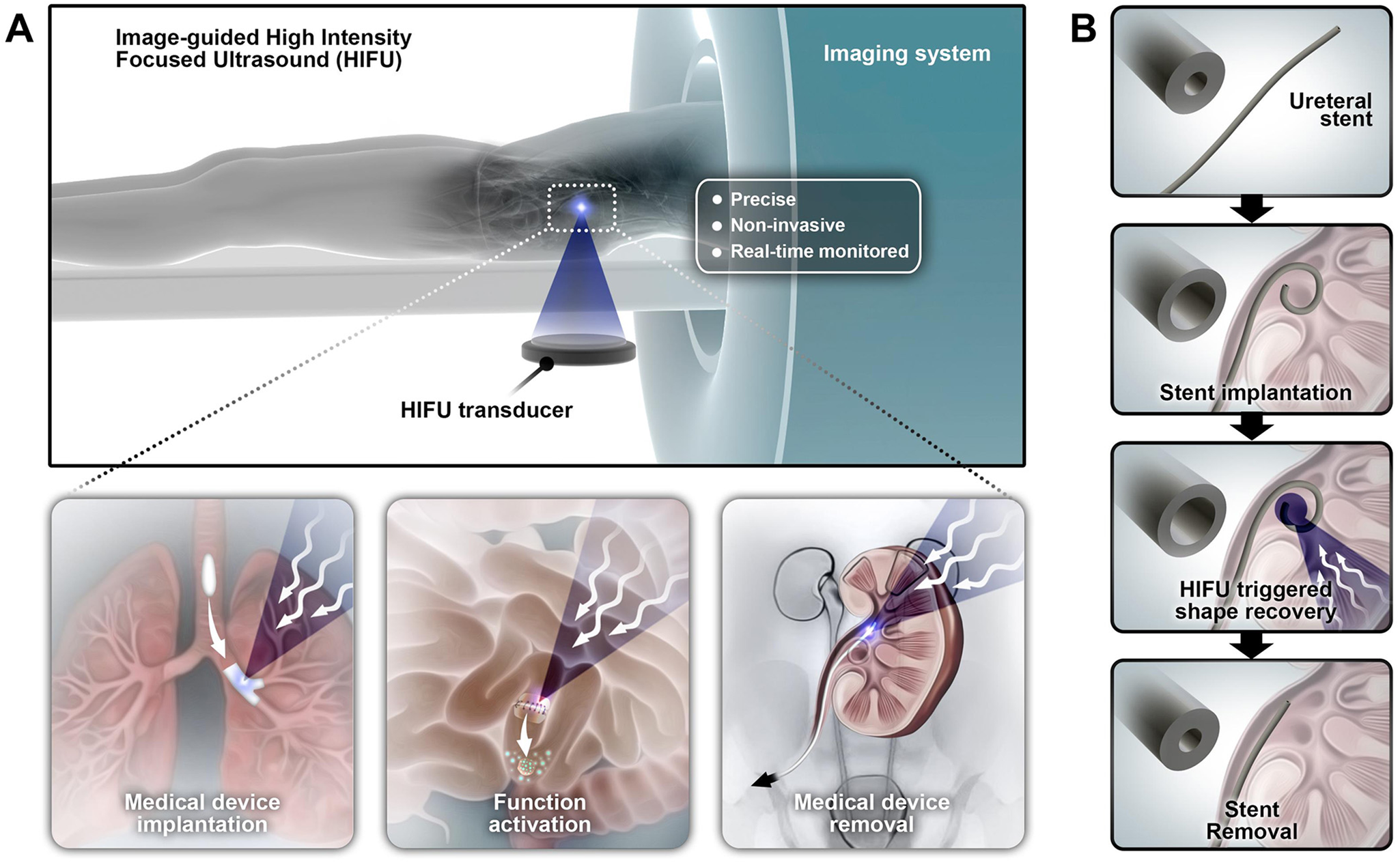 Shape-recovery of implanted shape-memory devices remotely 