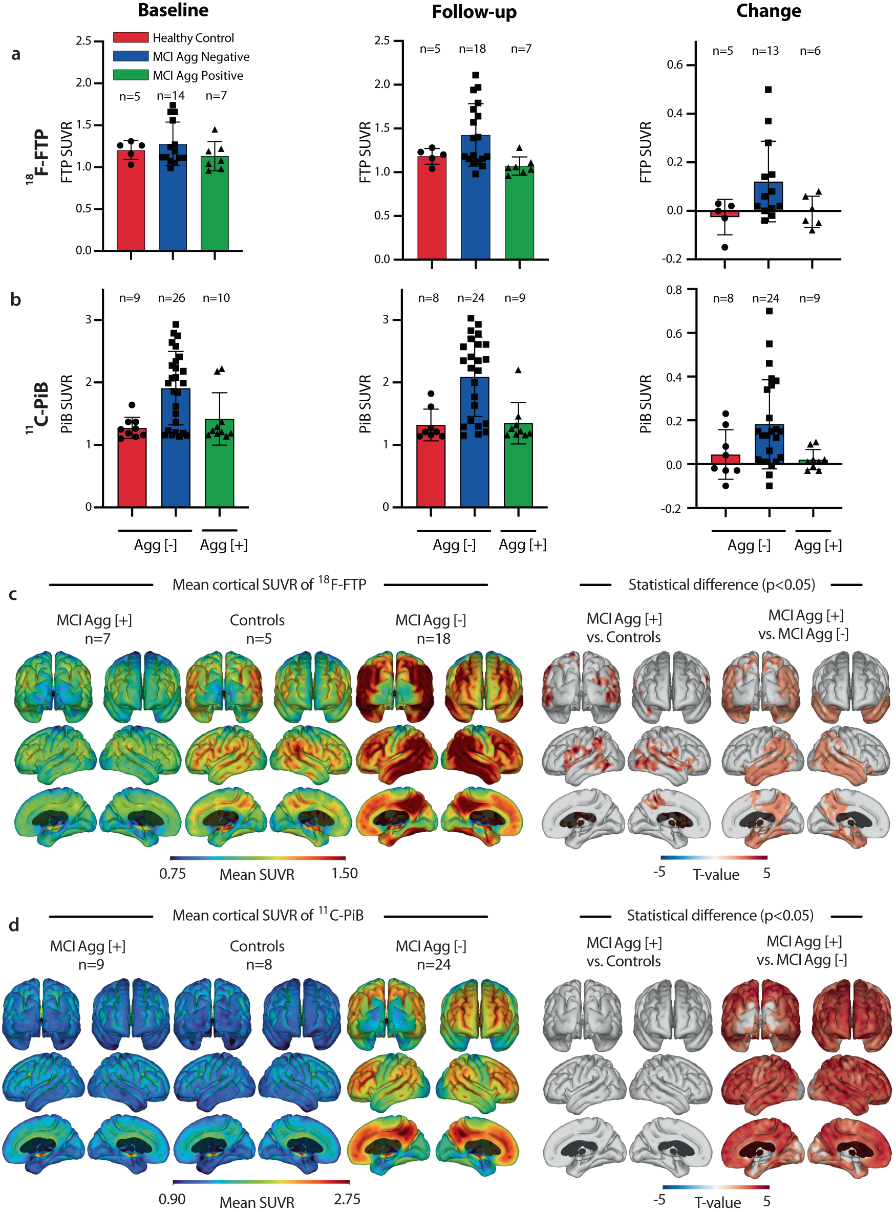 Fig. 3: Large Aβ Agg [+] MCI patients display lower AD-like brain pathology than large Aβ Agg [-] MCI.
