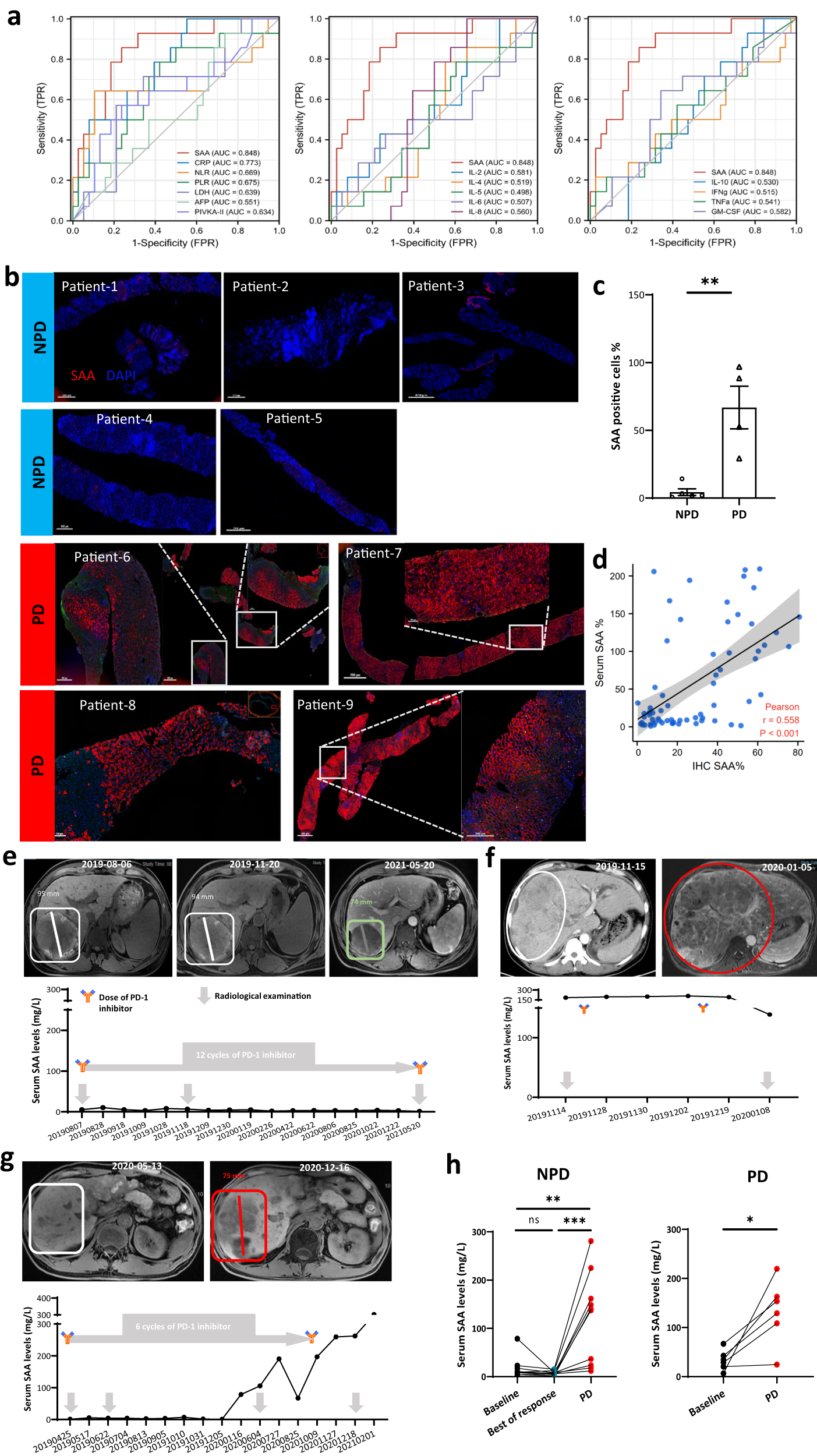 Fig. 1: SAA is associated with outcomes in aHCC patients treated with anti-PD-1.