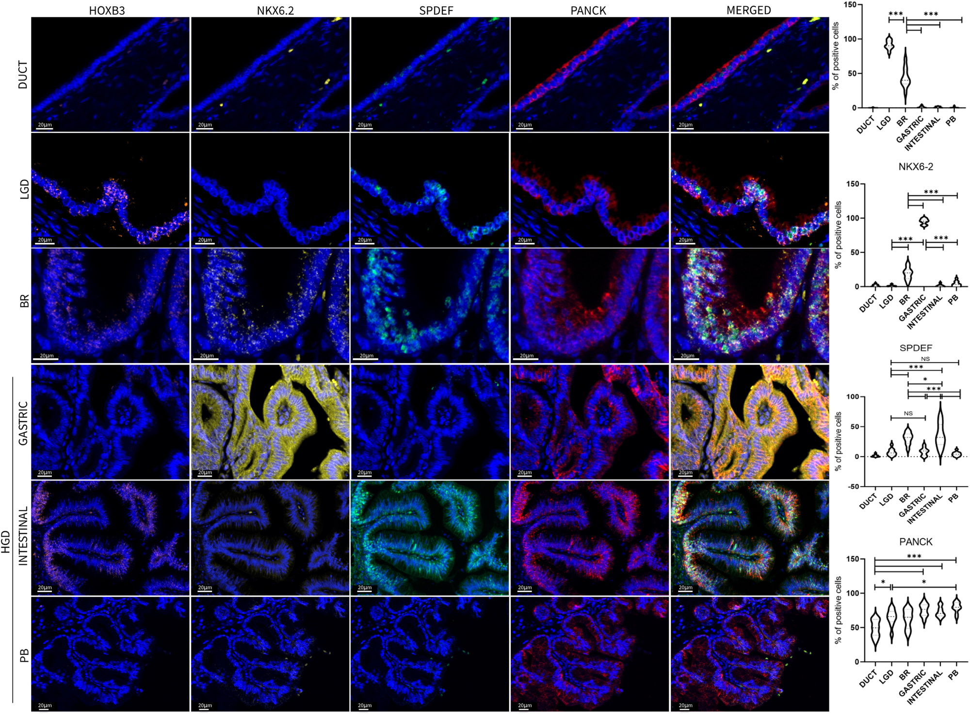 Fig. 8: Multiplex Immunofluorescence validation of the main markers identified by ST analysis.
