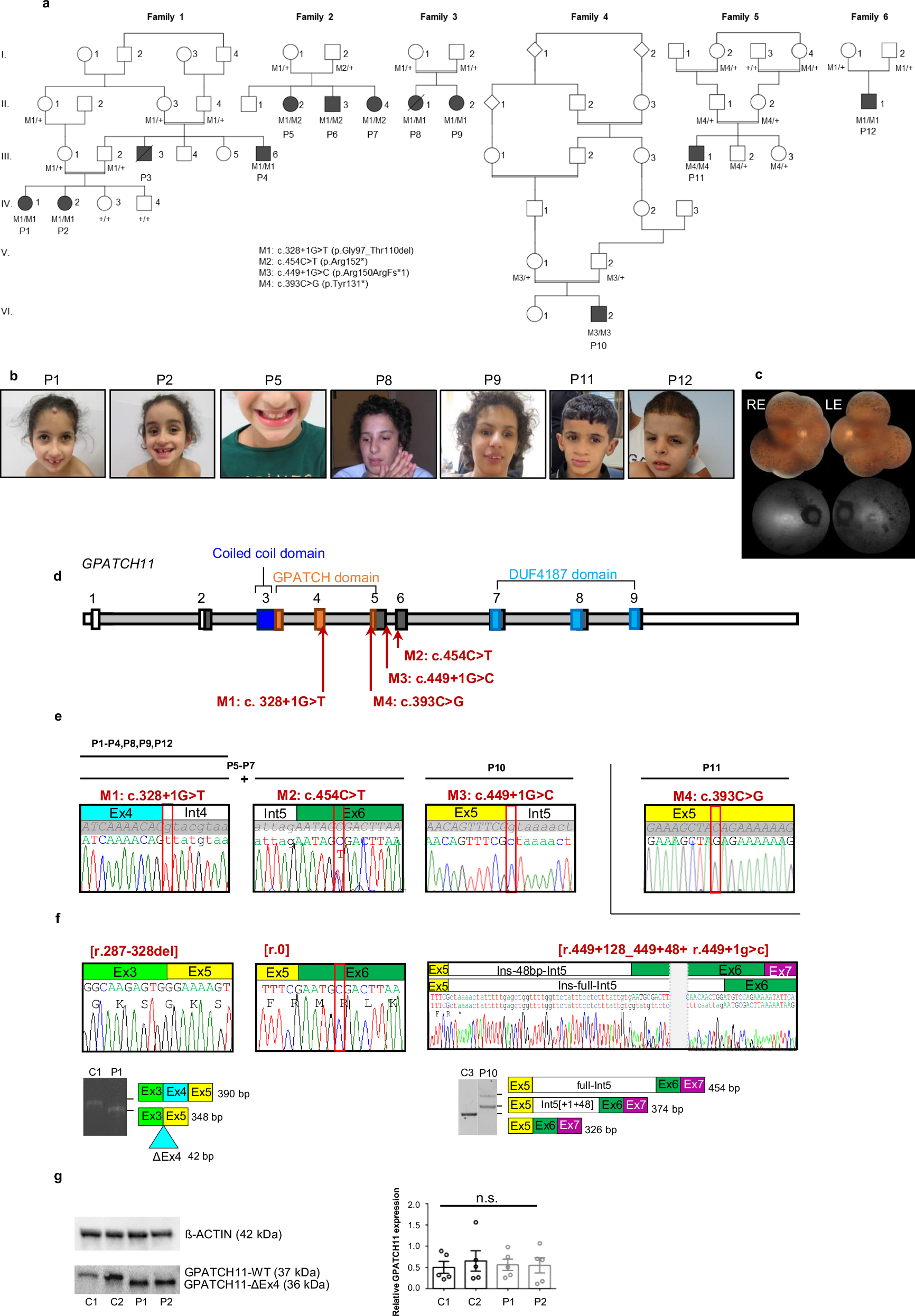 GPATCH11 variants cause mis-splicing and early-onset retinal dystrophy with neurological impairment | Nature Communications gpatch11-variants-cause-mis-splicing-and-early-onset-retinal-dystrophy-with-neurological-impairment-nature-communications