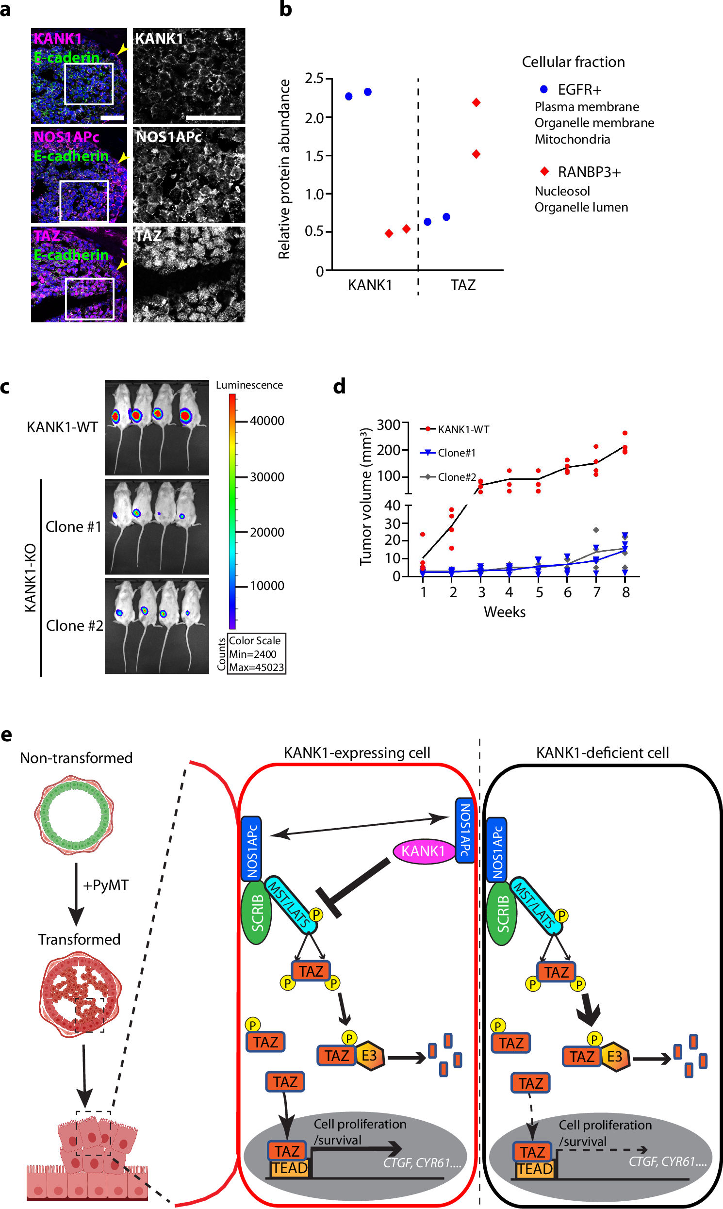 Fig. 10: KANK1 in human breast cancer.