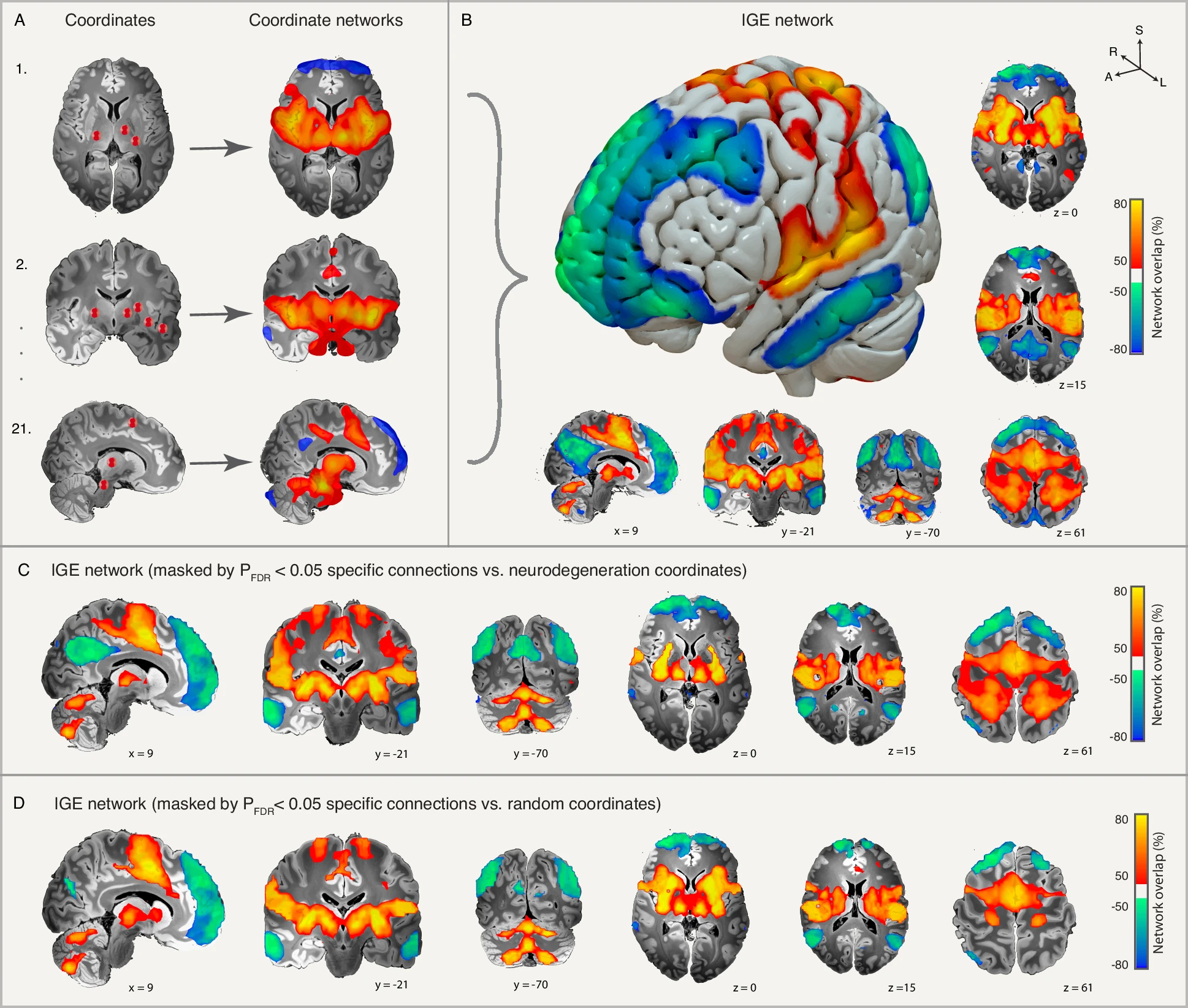 Research Spotlight: A Generalized Epilepsy Network Derived from Brain Abnormalities and Deep Brain Stimulation Research Spotlight: A Generalized Epilepsy Network Derived from Brain Abnormalities and Deep Brain Stimulation