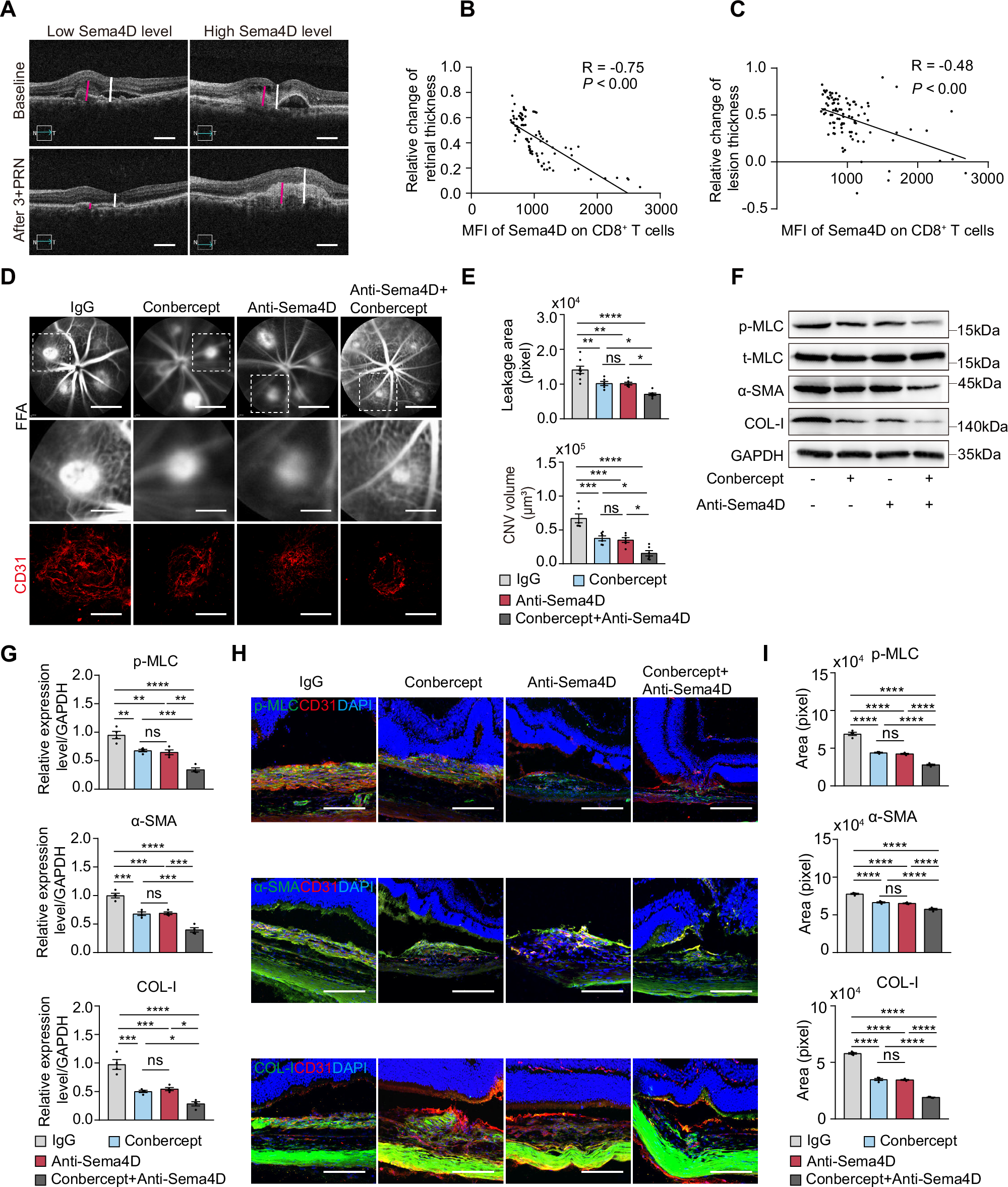 Fig. 8: Targeting Sema4D alleviates CNV progression and enhances anti-VEGF therapy efficacy.