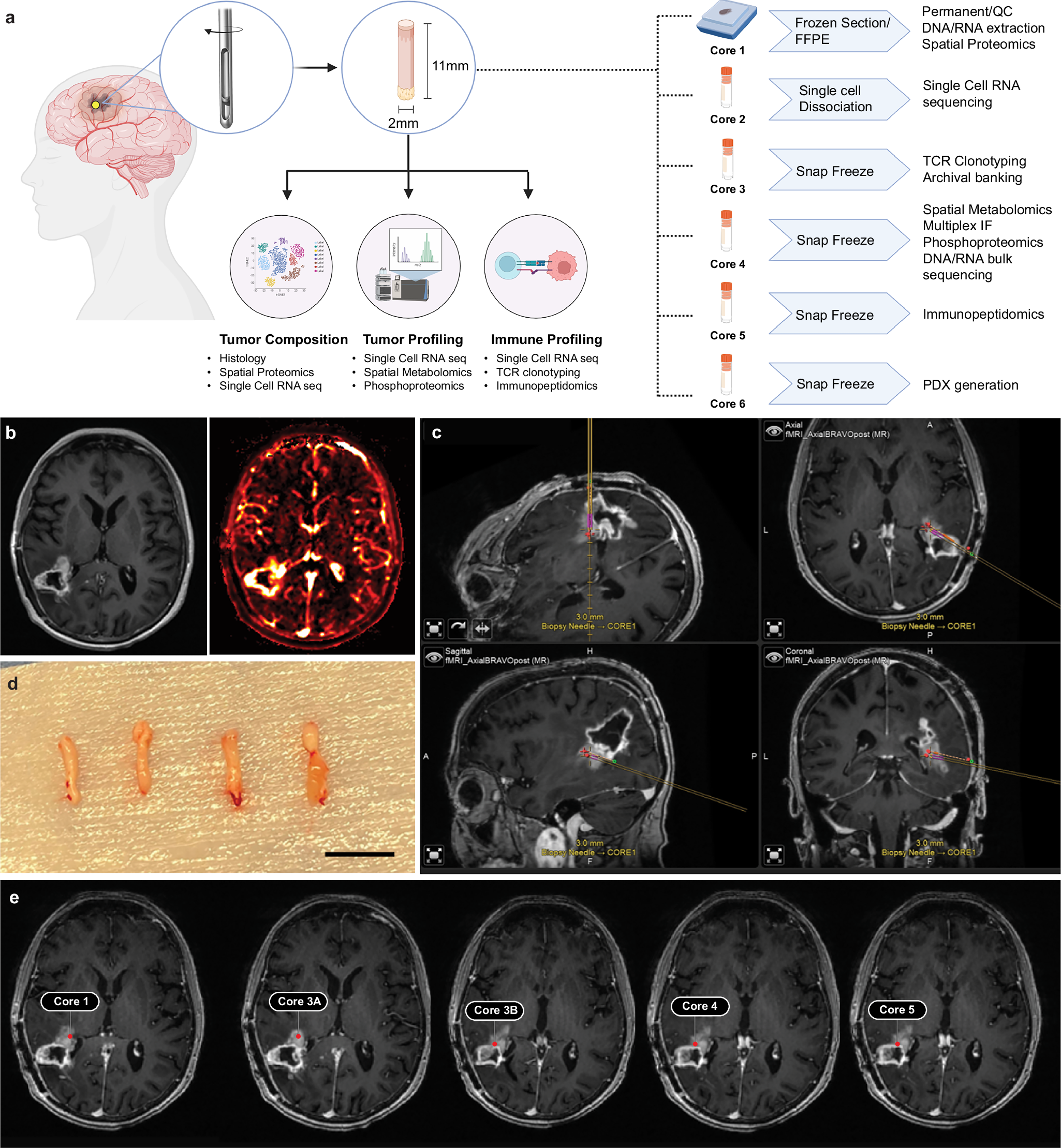 A detailed medical image showing a needle core biopsy for tumor analysis