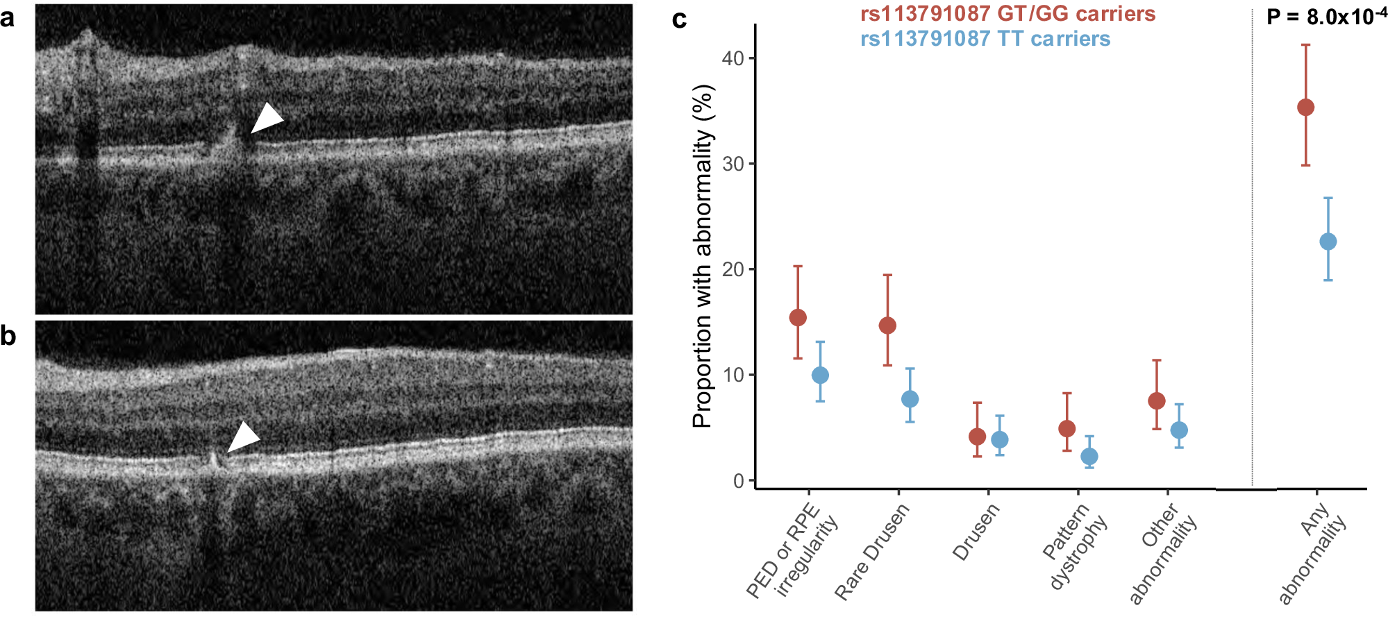 Fig. 3: Retinal abnormalities in optical coherence tomography images by PTPRB rs113791087 genotype status in UK Biobank.