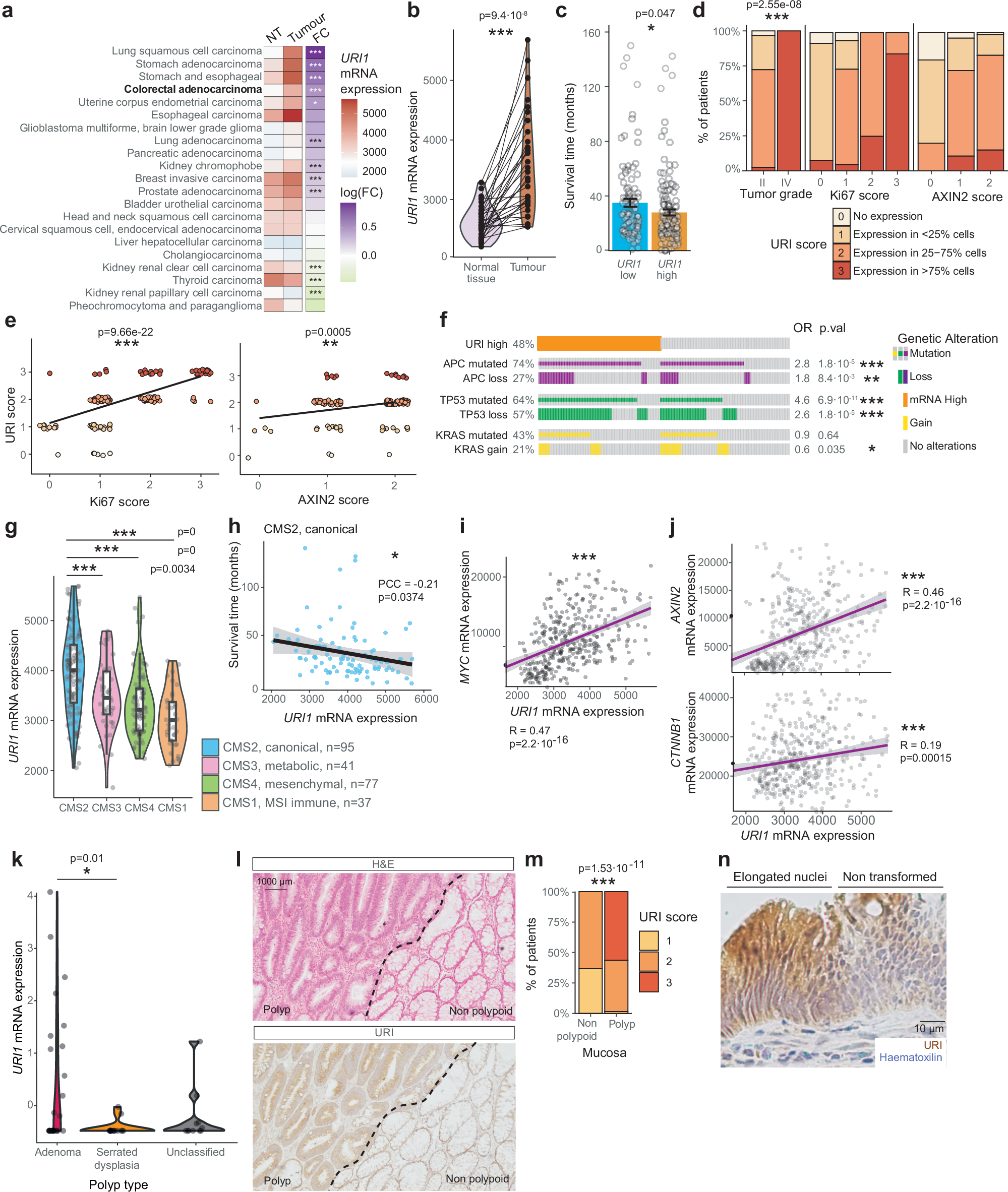 Fig. 1: URI is overexpressed in APC-loss driven human CRC, correlating with poor prognosis.