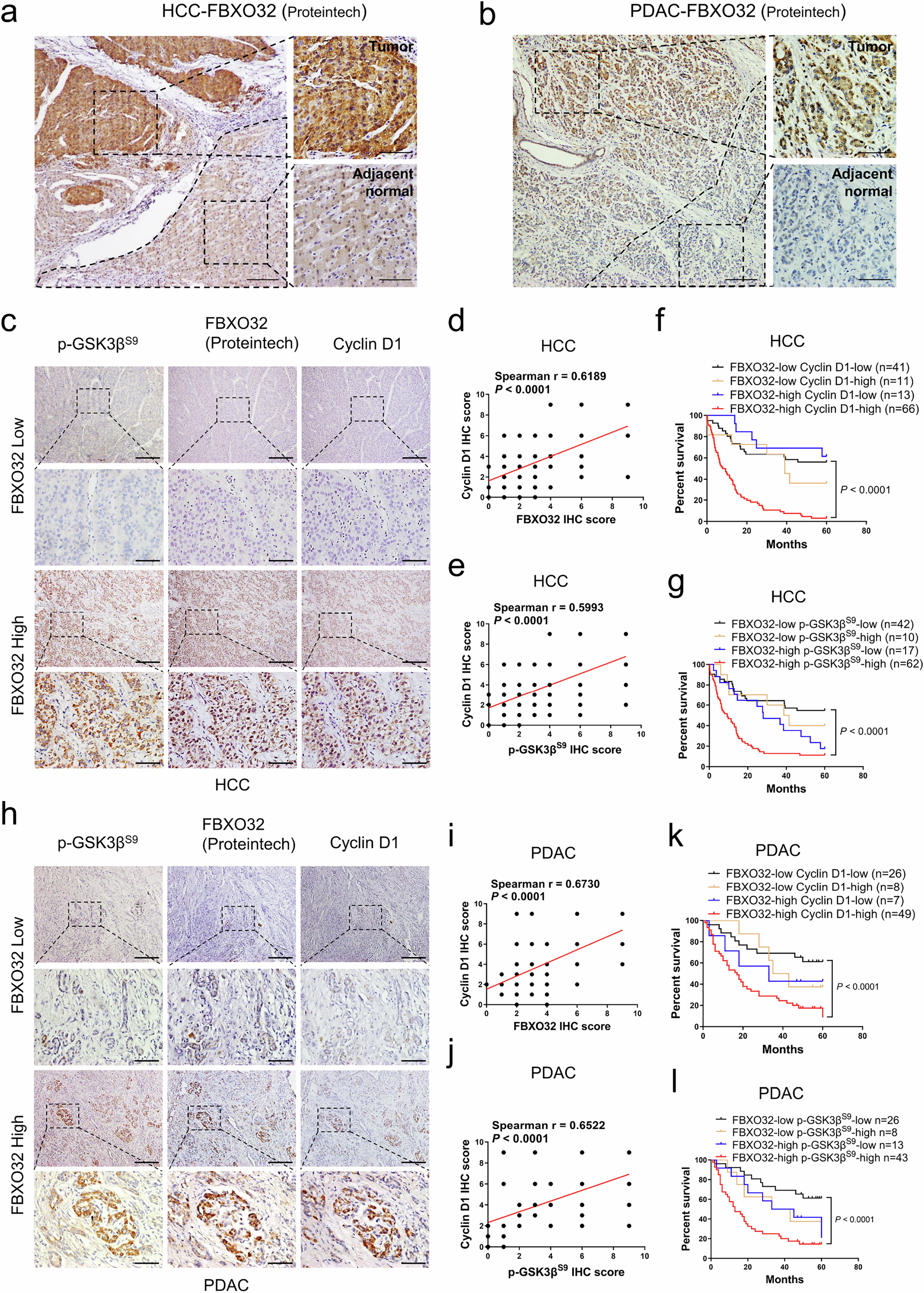 Fig. 8: FBXO32 and p-GSK-3βS9 protein level correlates positively with cyclin D1 protein level in HCC and PDAC patients.