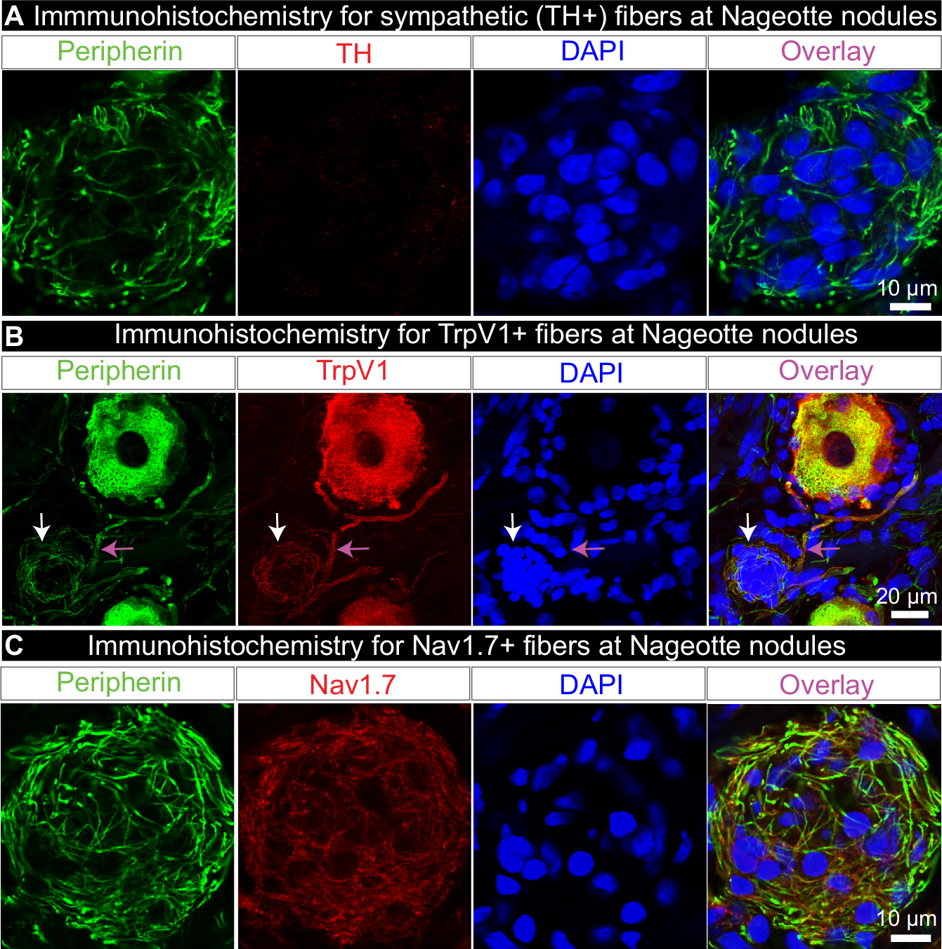 Fig. 2: Nageotte nodule axons express nociceptive, but not sympathetic markers.