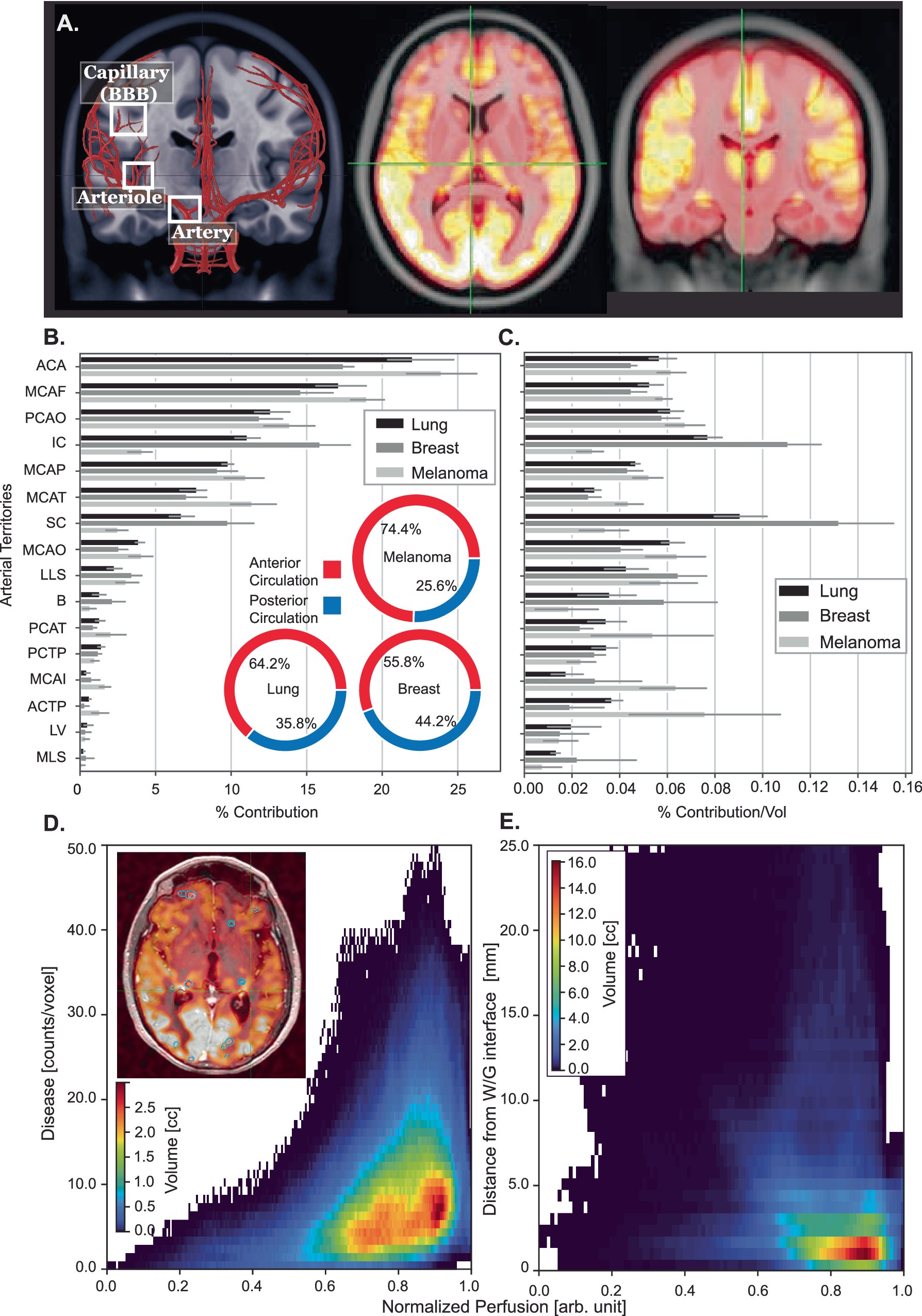 Fig. 4: Brain metastasis spatial distribution by level of perfusion and arterial territories.