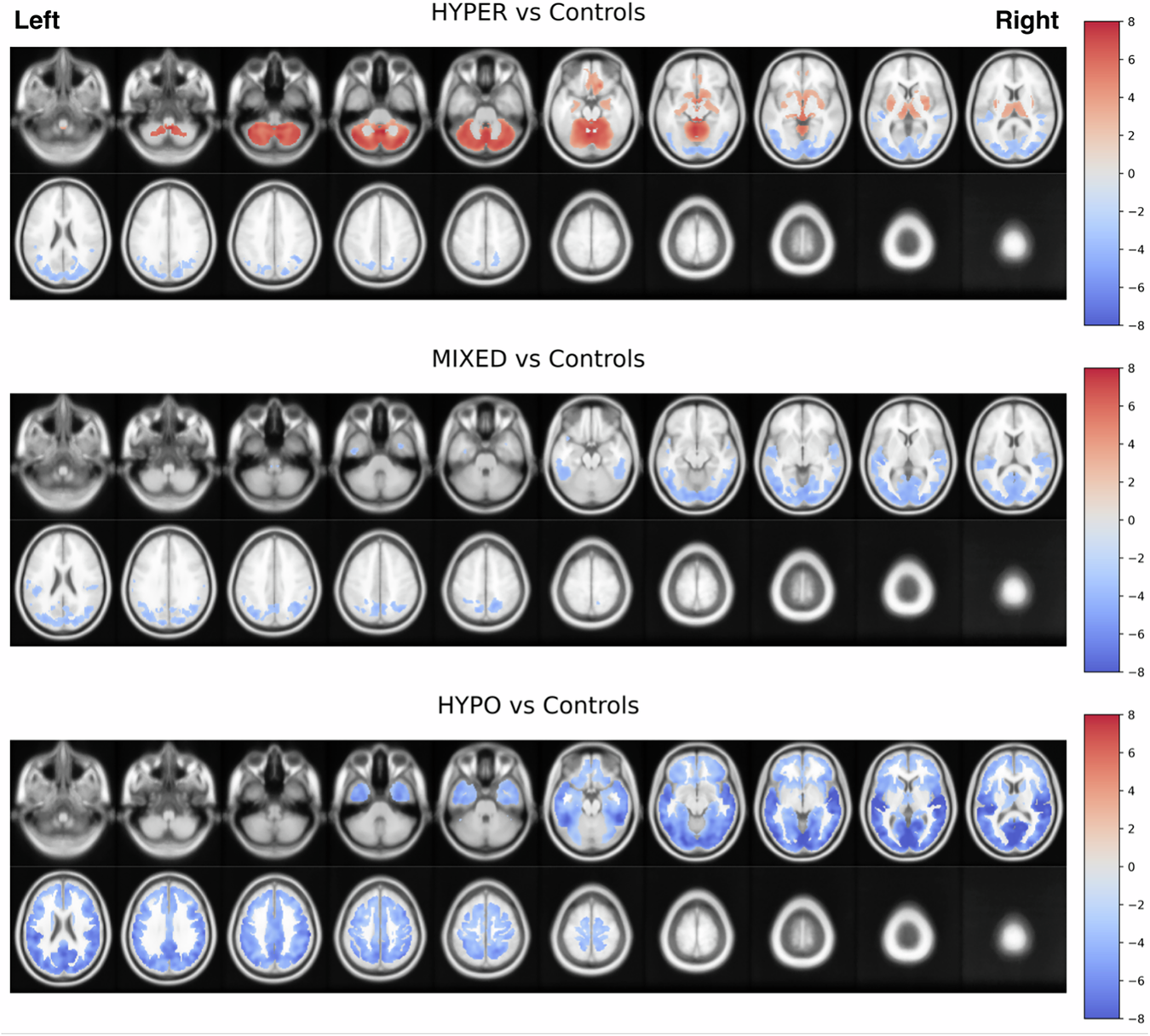 Fig. 2: Main voxel-based SPM analysis comparing each of the baseline cholinergic subgroups against control participants with independent samples t tests.