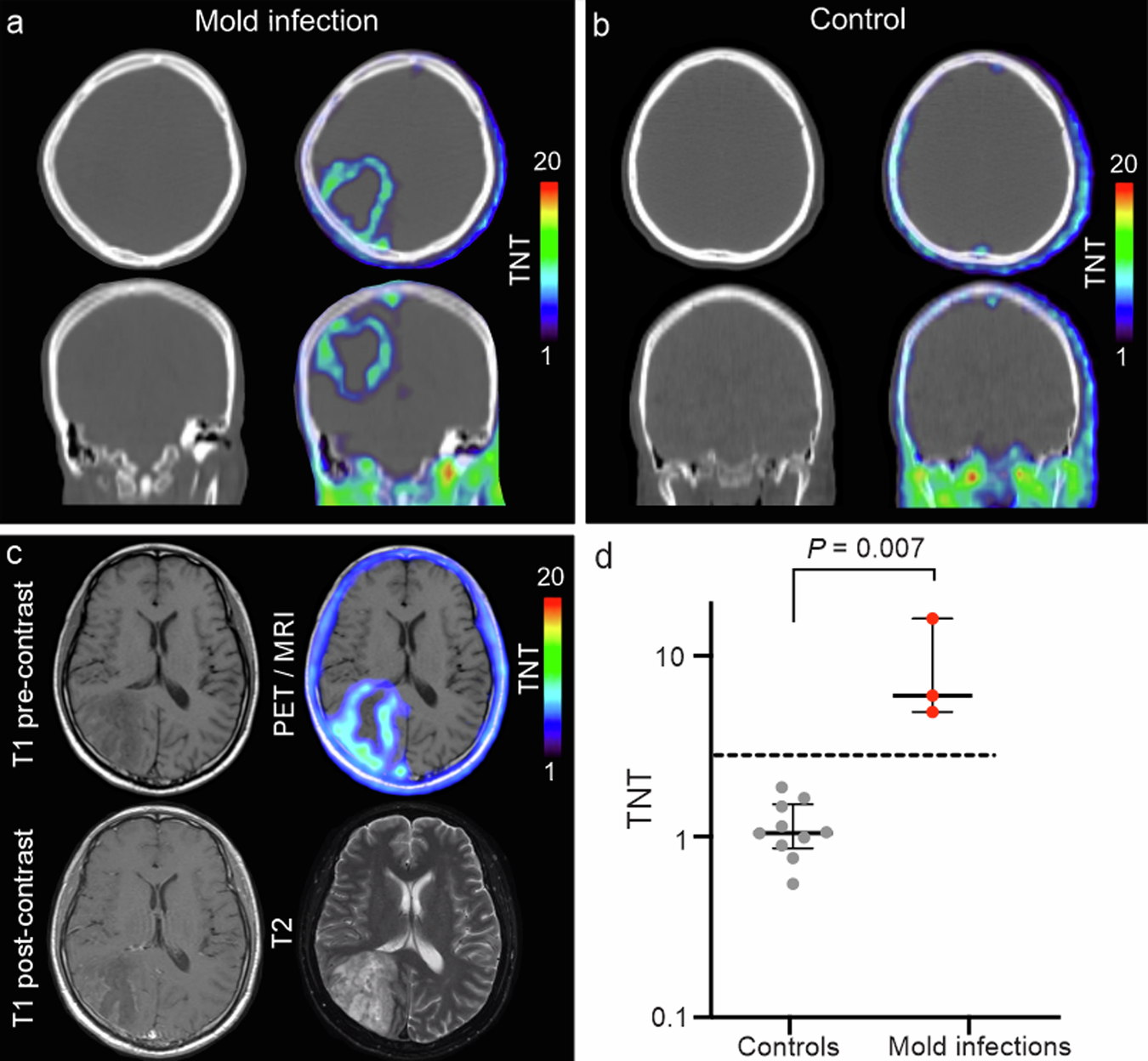 Fig. 4: Cranial 18F-FDS PET imaging in patients.