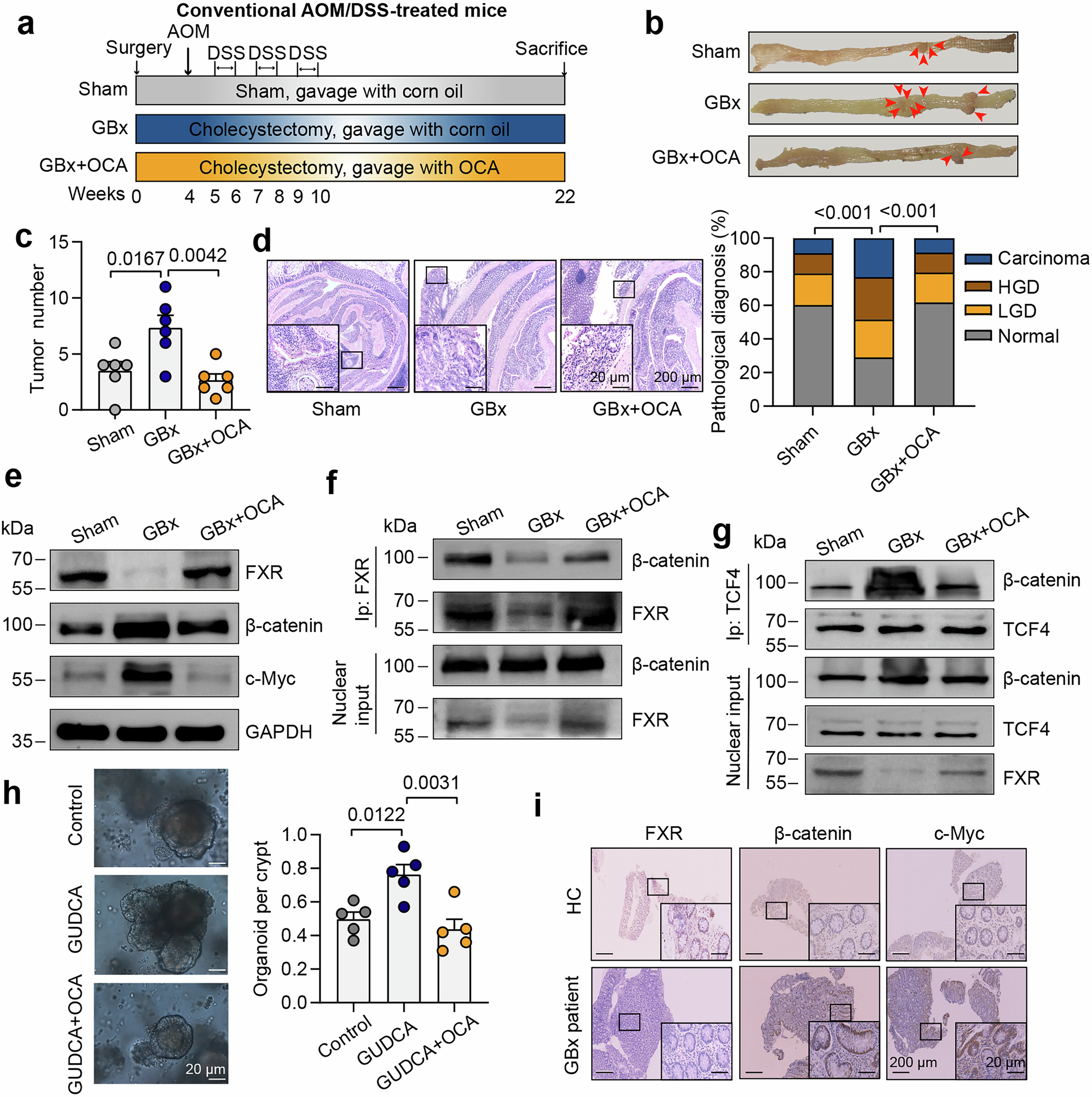 Fig. 7: OCA prevents cholecystectomy-induced colorectal tumorigenesis.