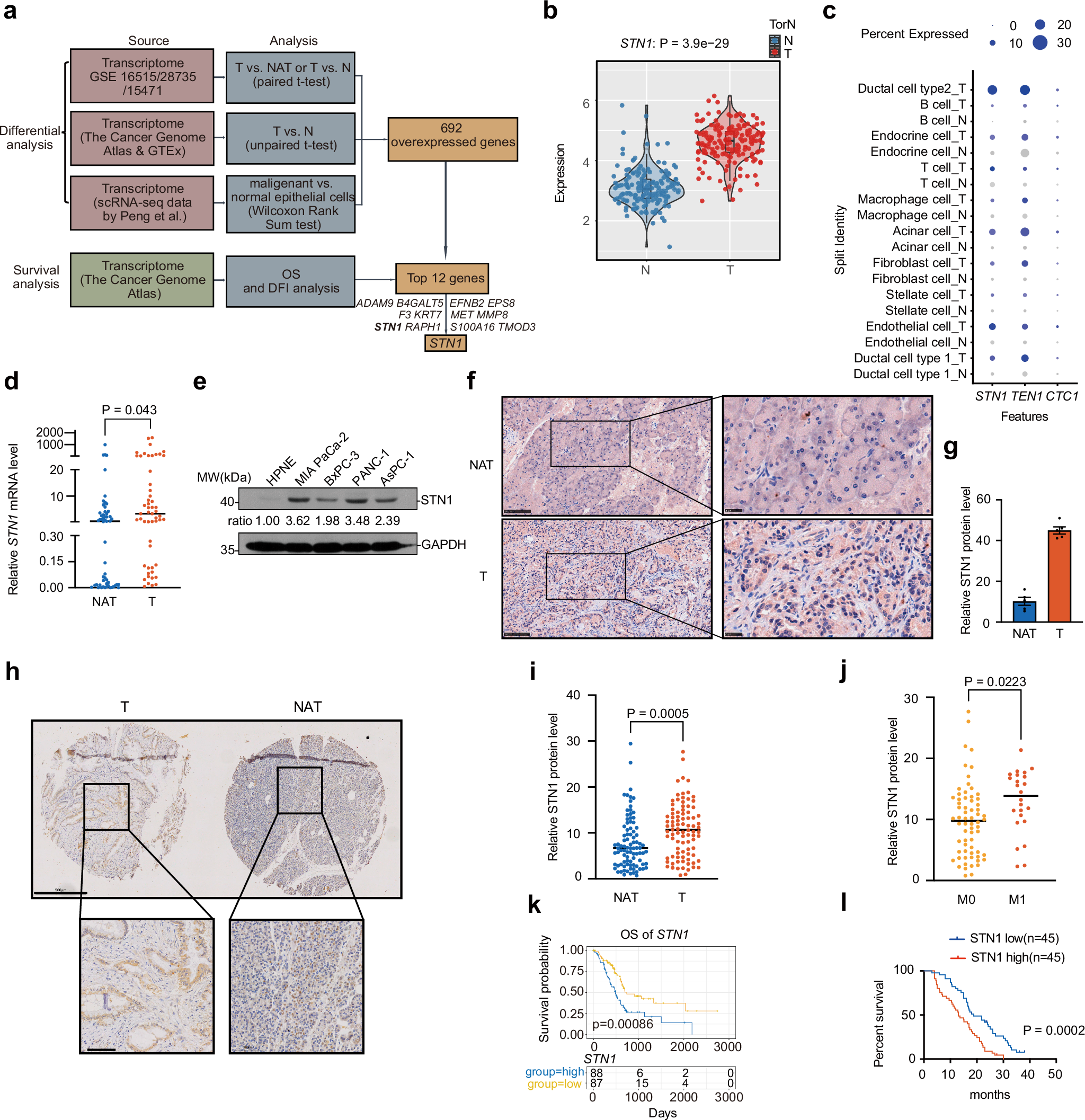 Fig. 1: Elevated STN1 expression is associated with adverse survival outcomes in PDAC patients.