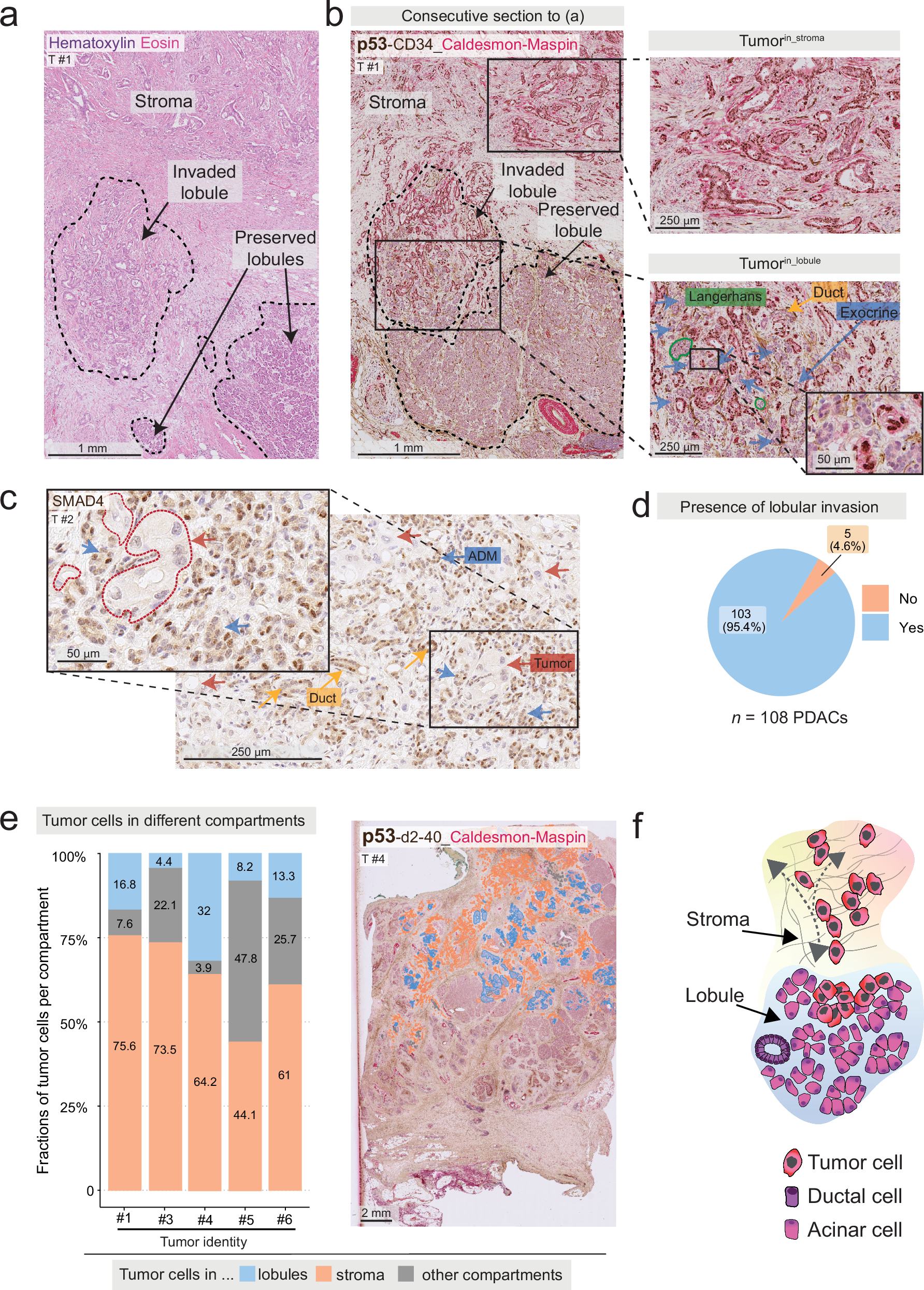 膵臓がん細胞は損傷組織を利用して増殖(Tumour cells exploit damaged tissue in the pancreas)