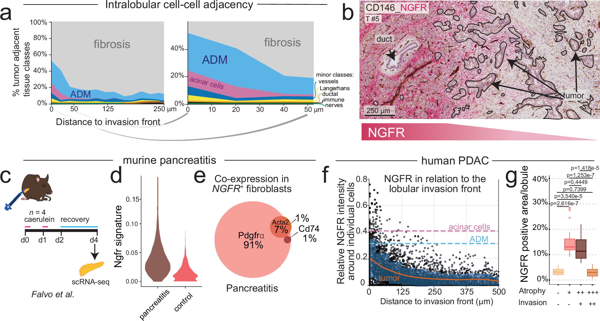 Fig. 4: Injury-induced stromal remodeling in lobular invasion.