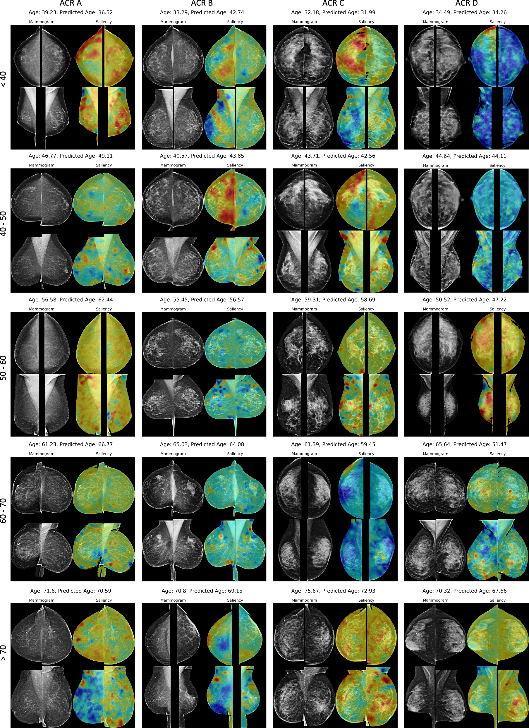 Fig. 4: Saliency map of the breast age prediction model.
