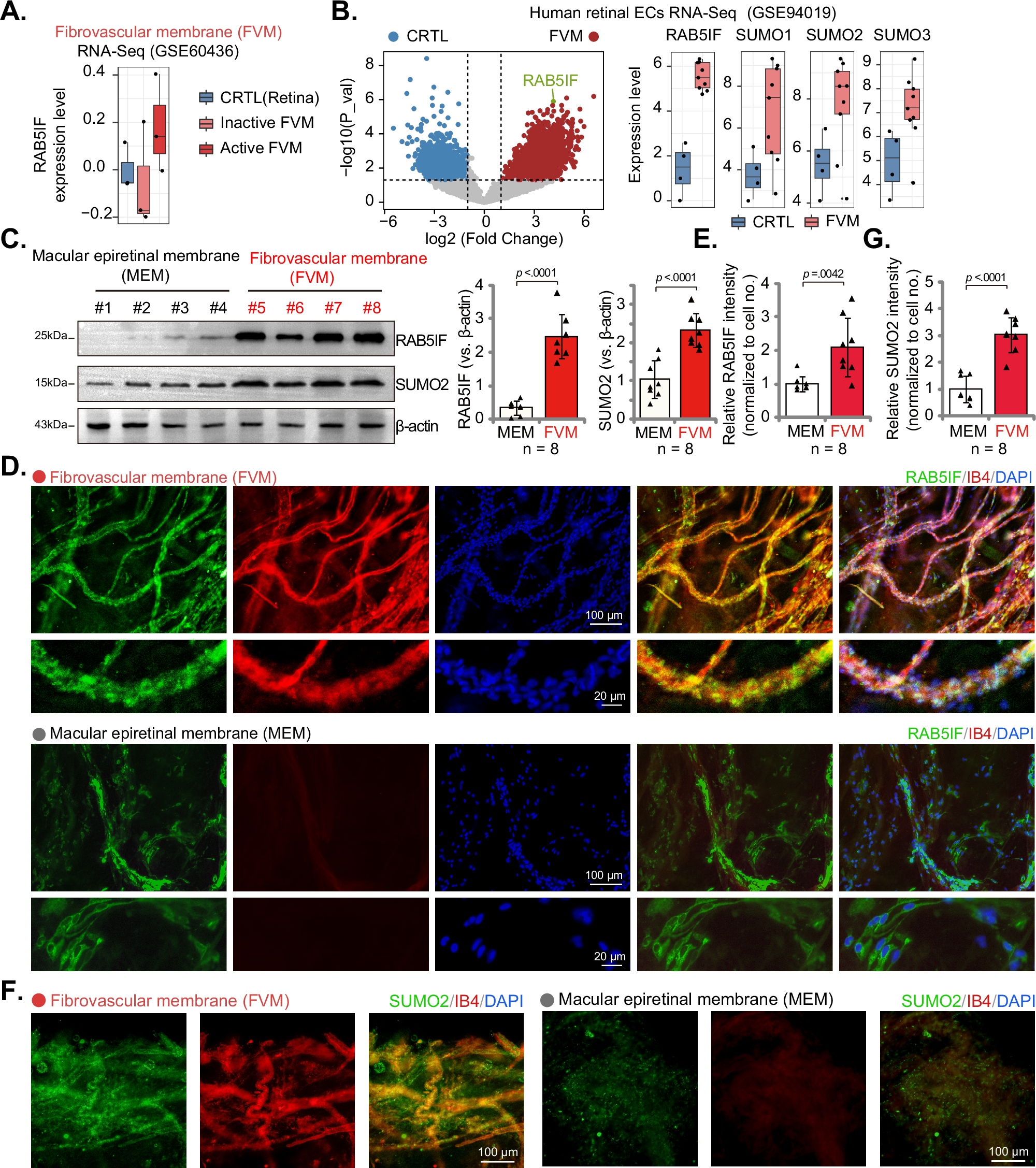 Fig. 9: Increased vascular expression of RAB5IF and SUMO2 in fibrovascular membranes of proliferative diabetic retinopathy patients.