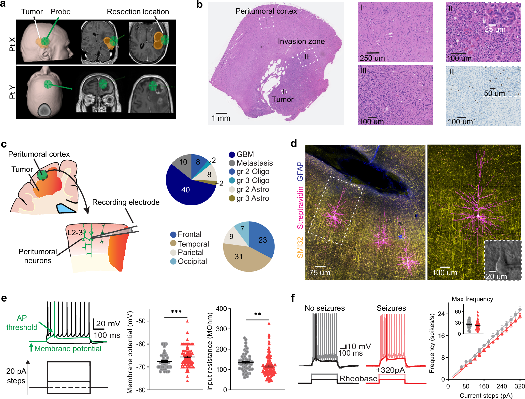 Fig. 1: Distinct intrinsic properties of L2/3 pyramidal neurons in the peritumoral cortex of brain tumor patients with and without seizures.