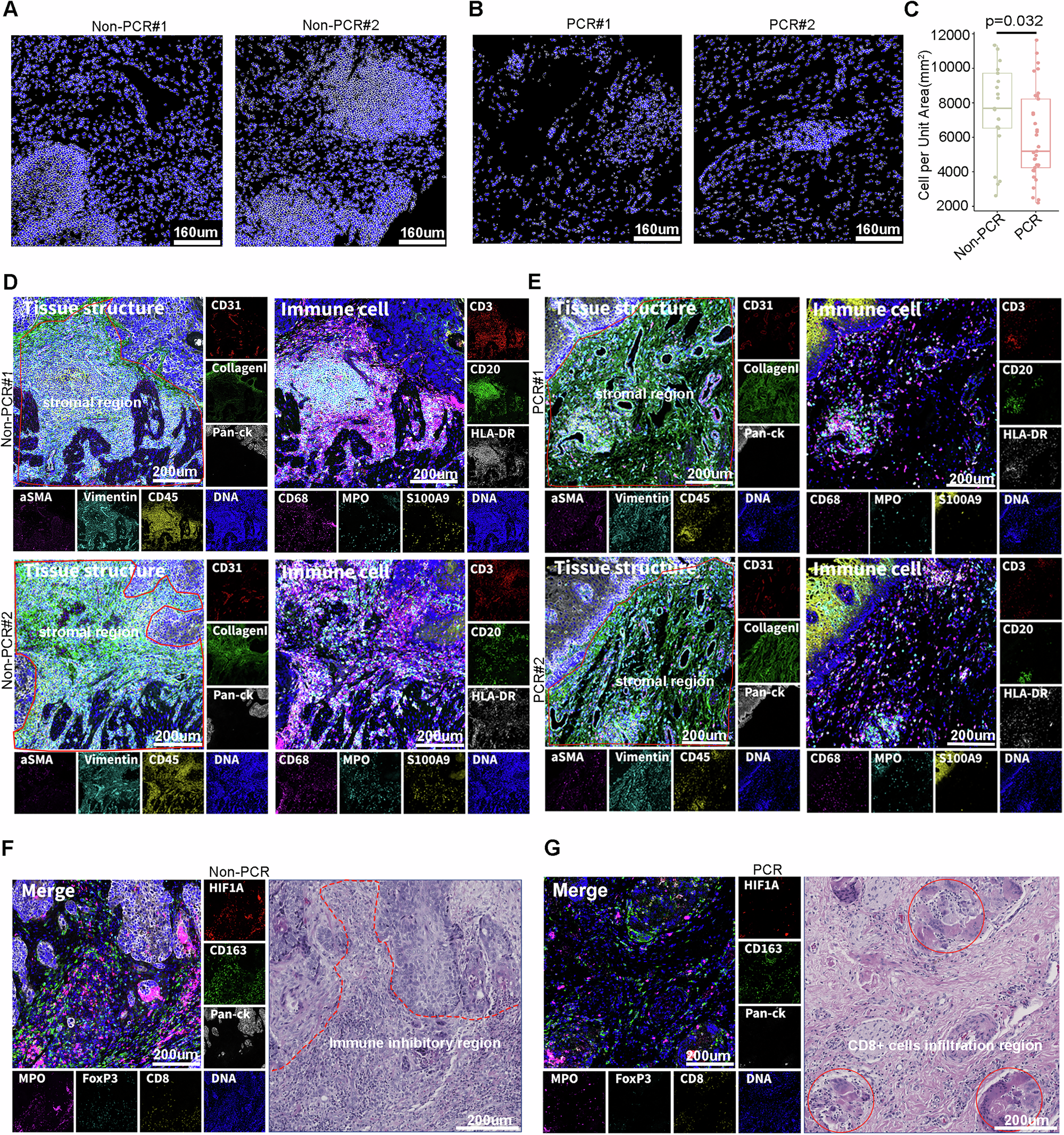 Fig. 3: Immune landscape and cellular distribution characteristics of postimmunotherapy oesophageal squamous cell carcinoma (ESCC).