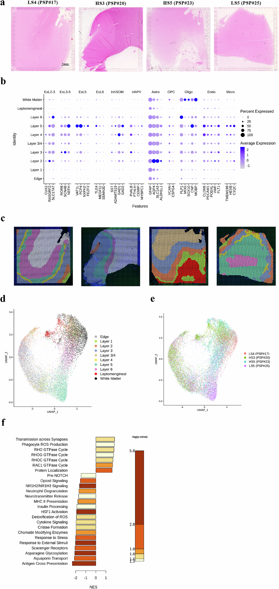 Fig. 7: Spatial transcriptomics reveals immune and neuronal dysregulation in high-seeder PSP cases.