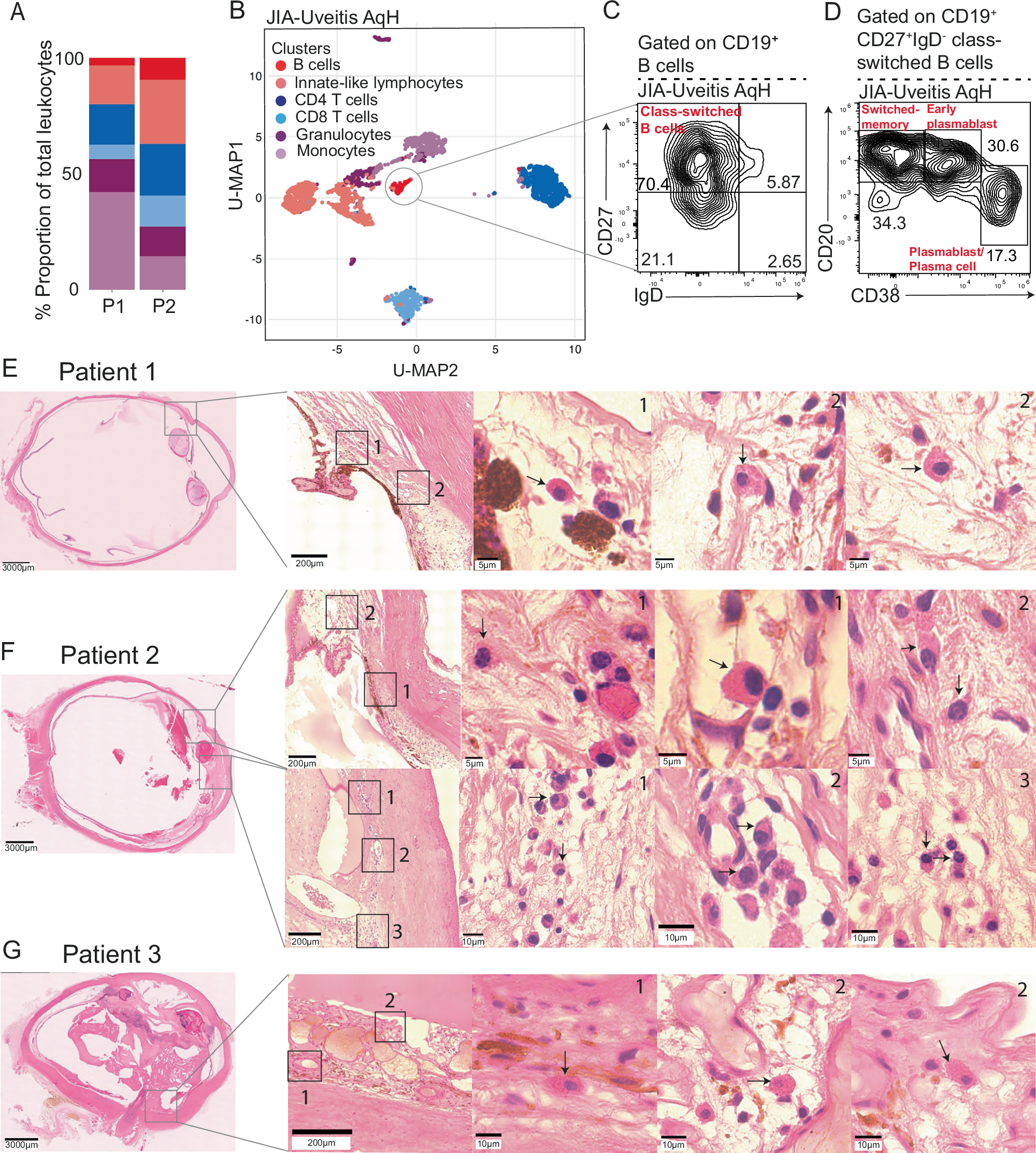 Fig. 4: B cells and plasma cells infiltrate the ocular compartment in JIA-uveitis patients.