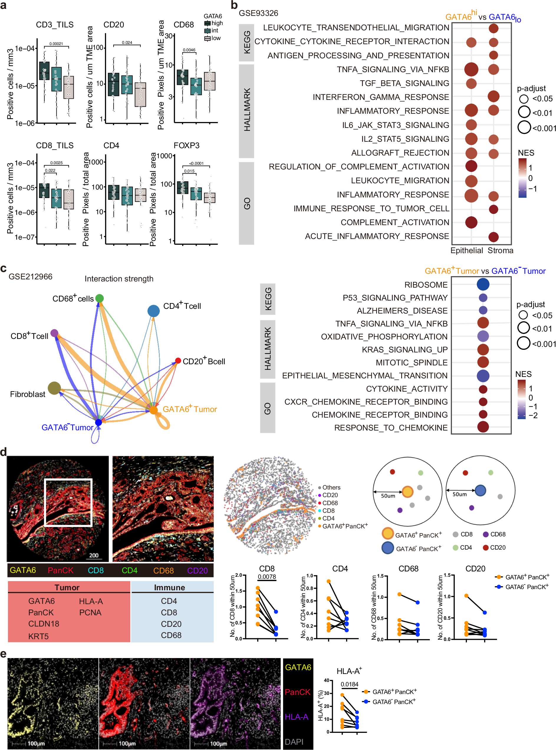 Fig. 1: GATA6 expression associates with immunoreactive stroma in human PDAC.