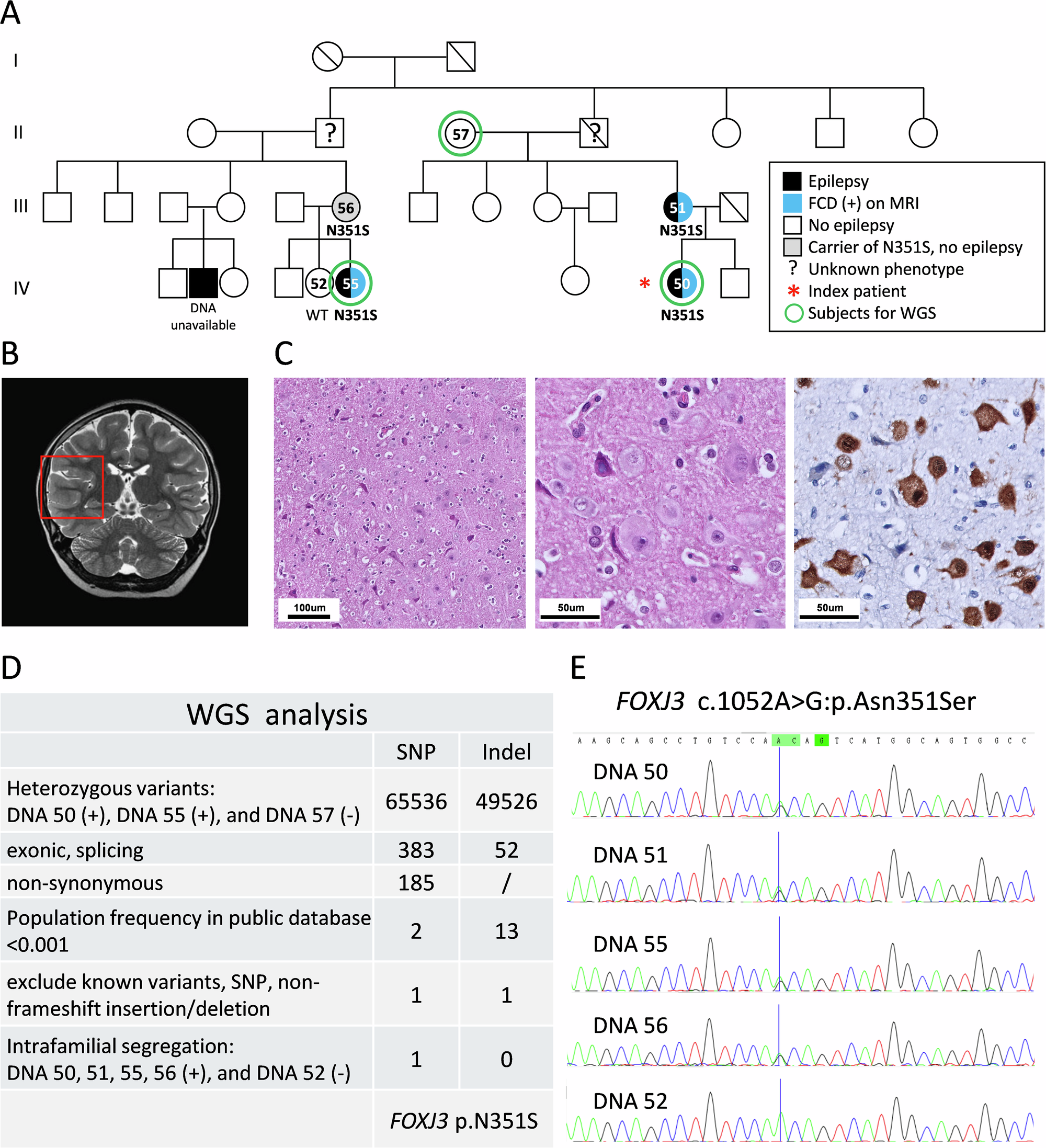 Fig. 1: Genetic and pedigree analysis of a family with focal epilepsy and focal cortical dysplasia associated with a novel FOXJ3 variant.