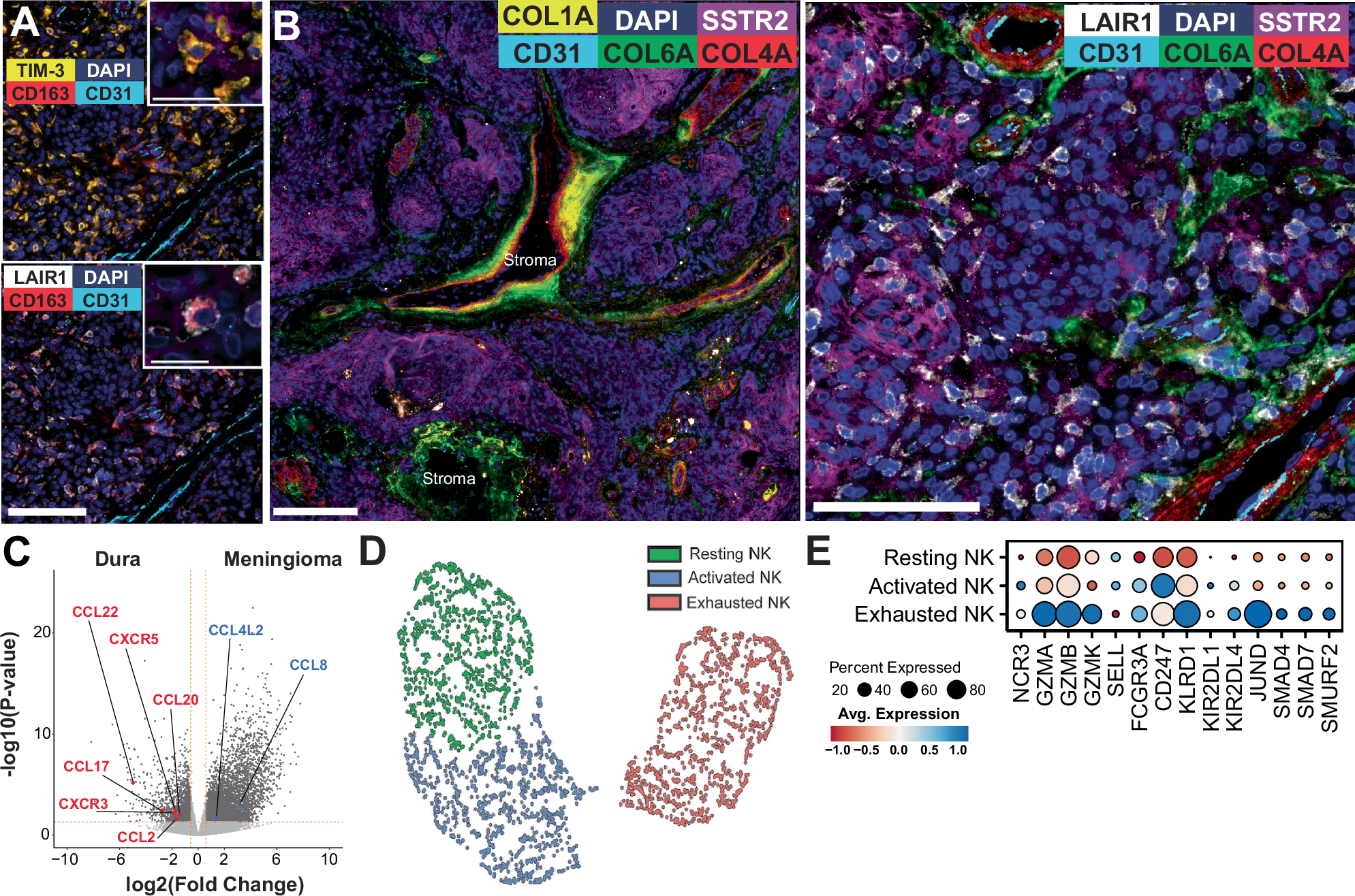 Fig. 2: Collagen-mediated immune suppression is present within meningiomas.