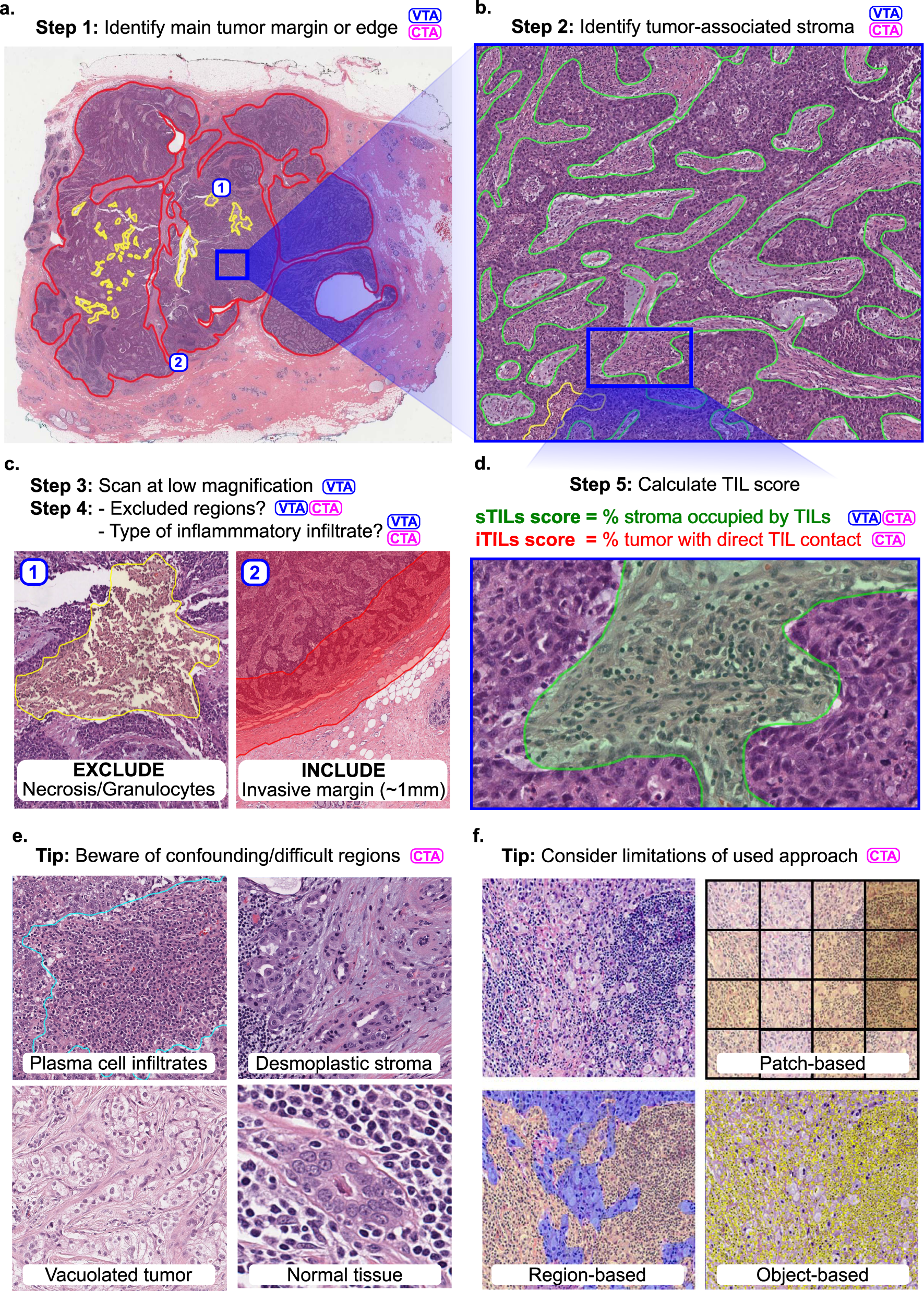 Fig. 1: Outline of the visual (VTA) and computational (CTA) procedure for scoring TILs in breast carcinomas.