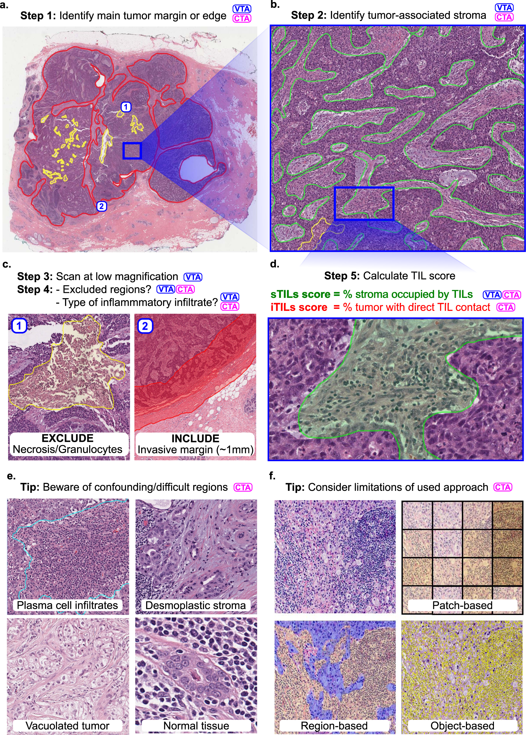 Report on computational assessment of Tumor Infiltrating Lymphocytes from  the International Immuno-Oncology Biomarker Working Group | npj Breast  Cancer