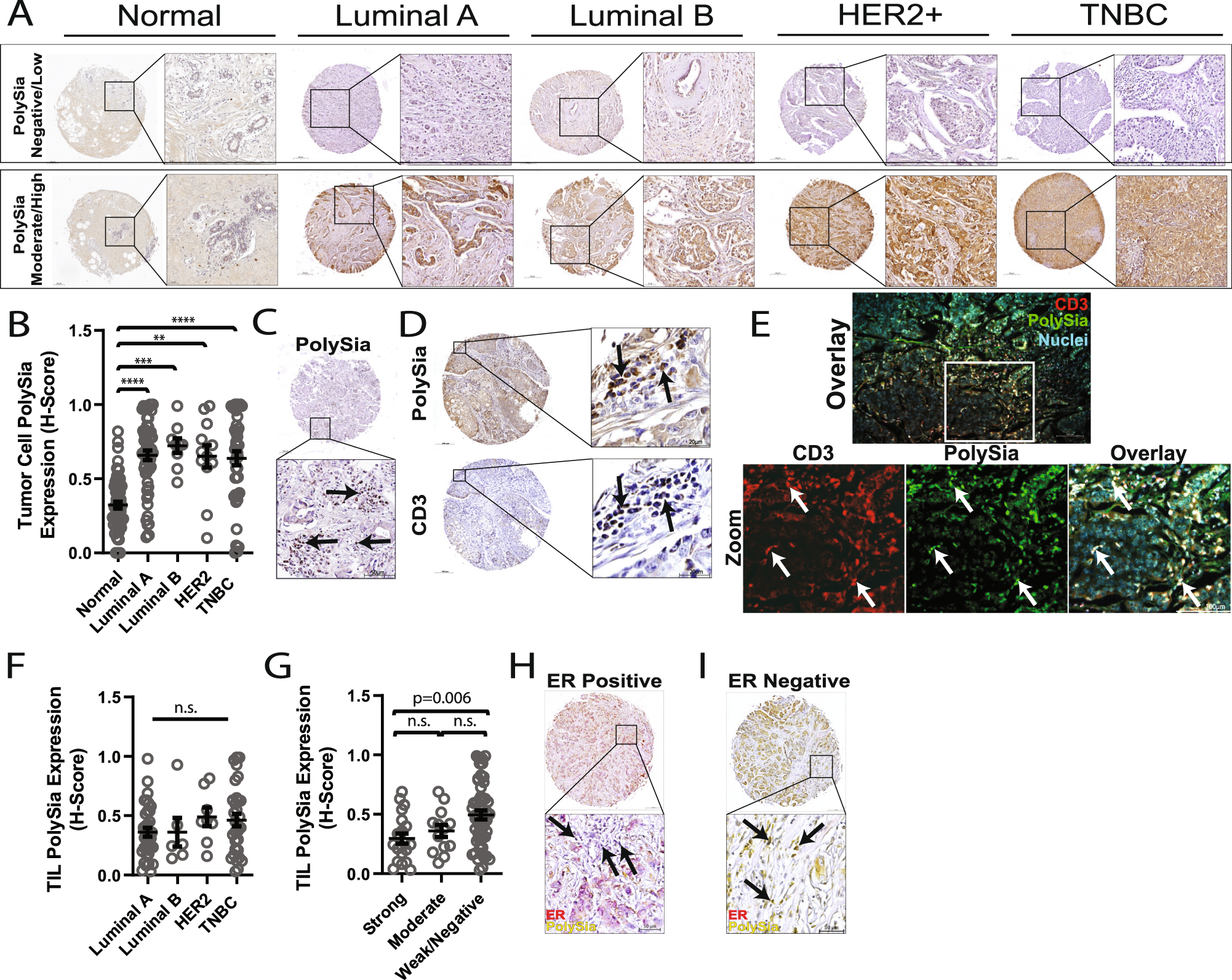 Fig. 1: Polysialic acid expression in primary breast tumors.