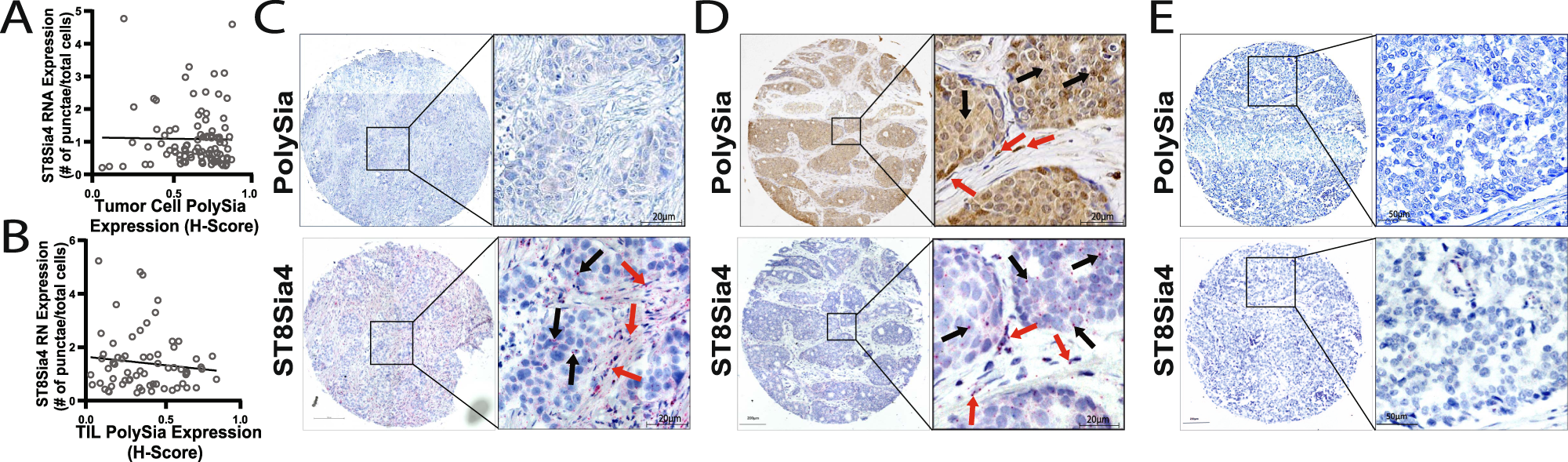 Fig. 3: PolySia and ST8Sia4 expression in tumor cells and tumor-infiltrating lymphocytes.