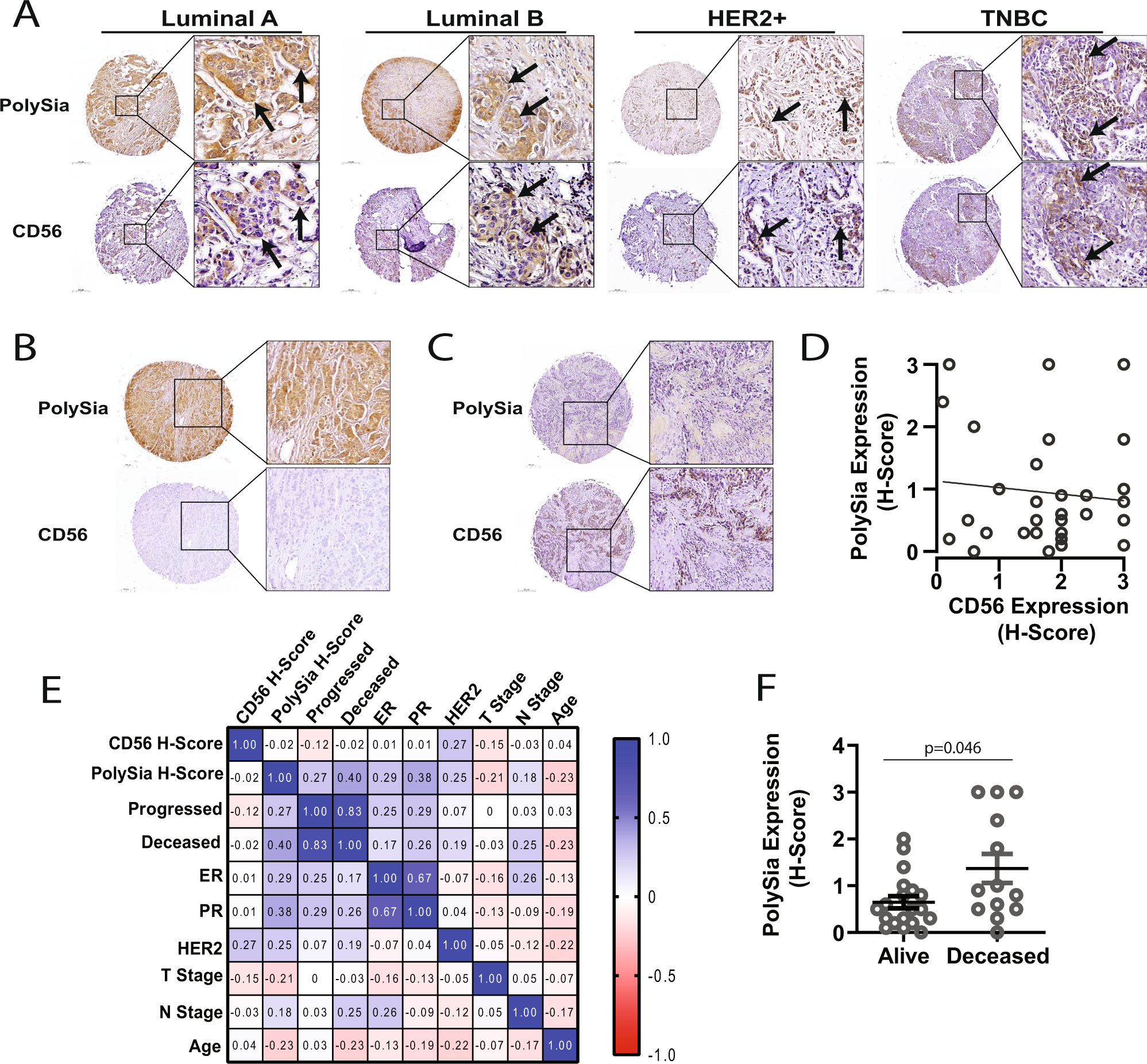 Fig. 5: PolySia and CD56 expression in primary breast tumors.