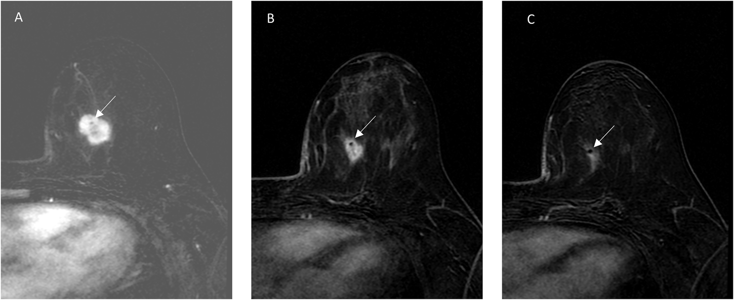 Fig. 2: A 44 year-old woman with TNBC undergoing NAST.