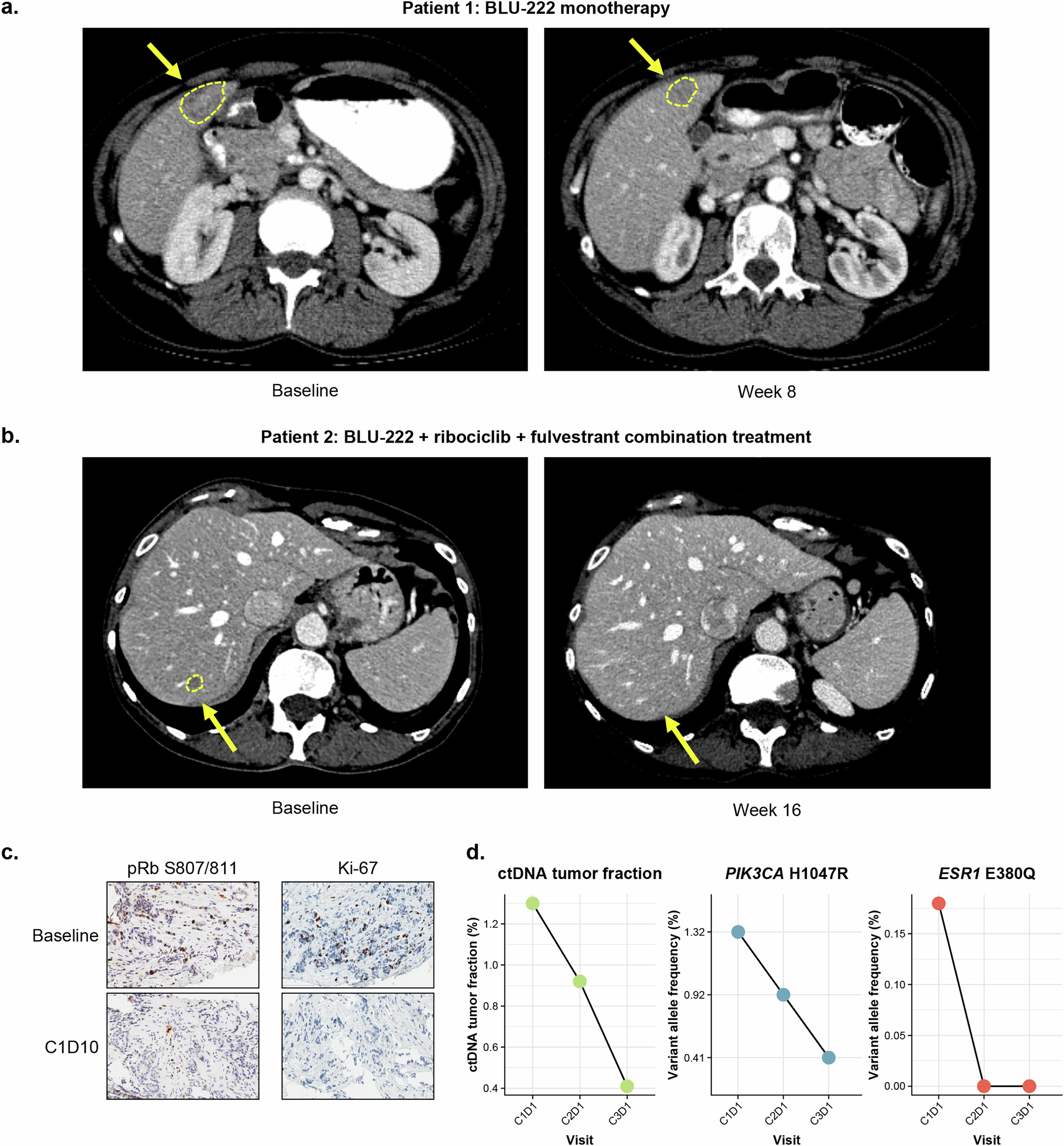 Fig. 7: Emerging BLU-222 clinical data demonstrate early evidence of activity as monotherapy or in combination with ribociclib + ET in patients with breast cancer.