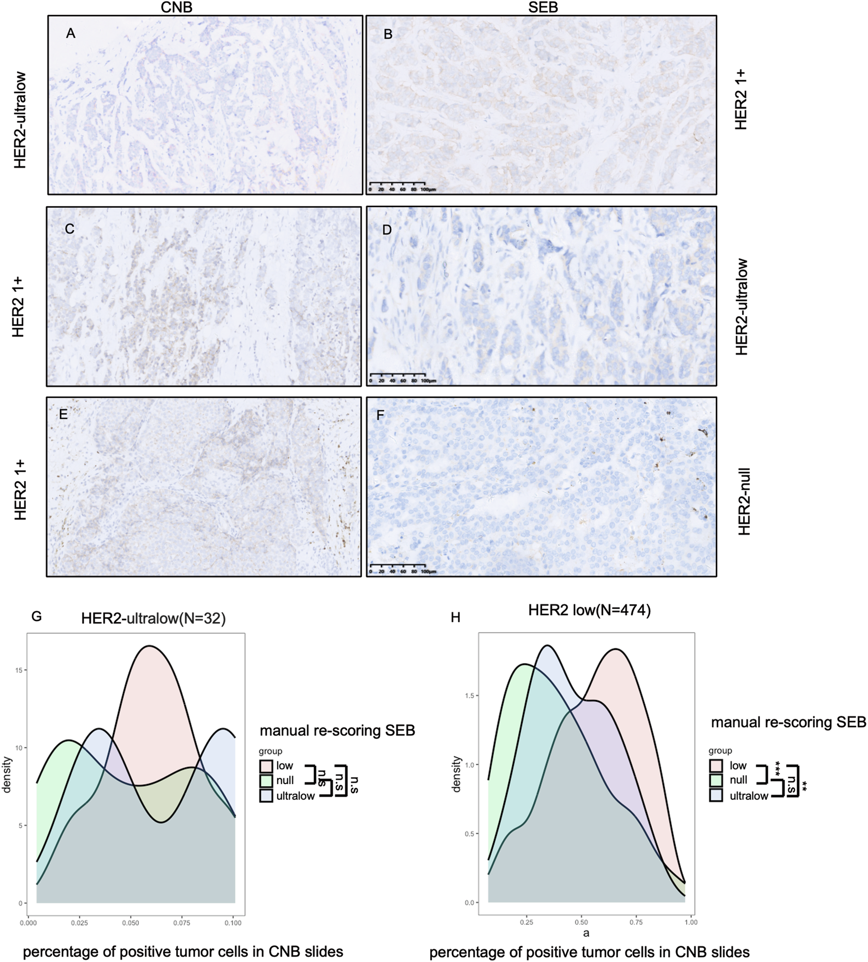 Fig. 3: HER2 status conversion between core needle biopsy (CNB) and surgical excision specimens (SEB).